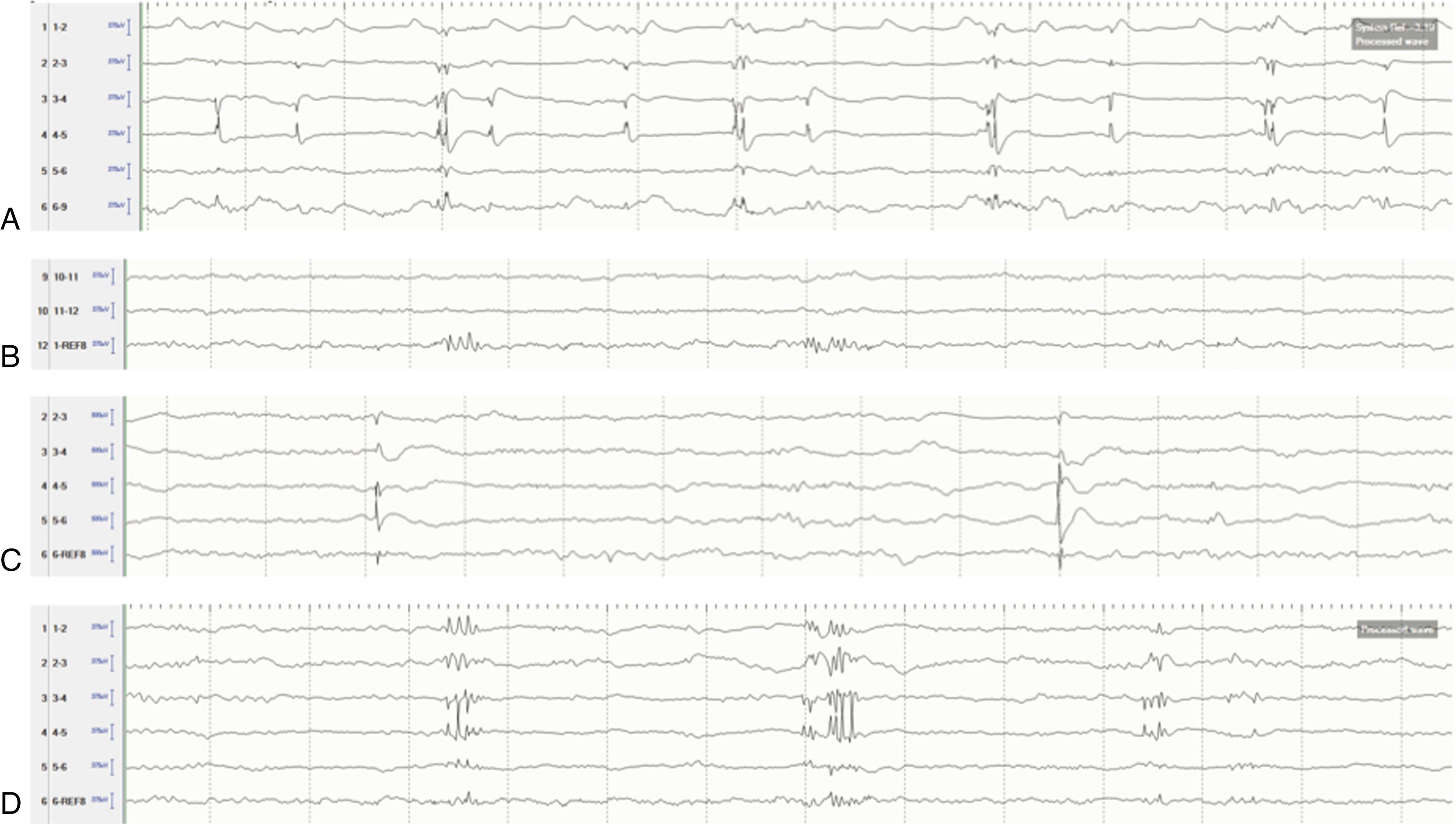 Figure 91.1, Representative electrocorticography (ECoG) findings in patients.