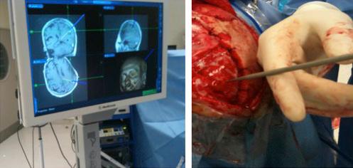 Fig. 14.2, A representative example of the intraoperative use of the StealthStation S7. After satisfactory patient registration is confirmed ( left ), the sterile pointer is placed over an area of interest ( right ), which corresponds with the patient’s preoperative MRI scans.