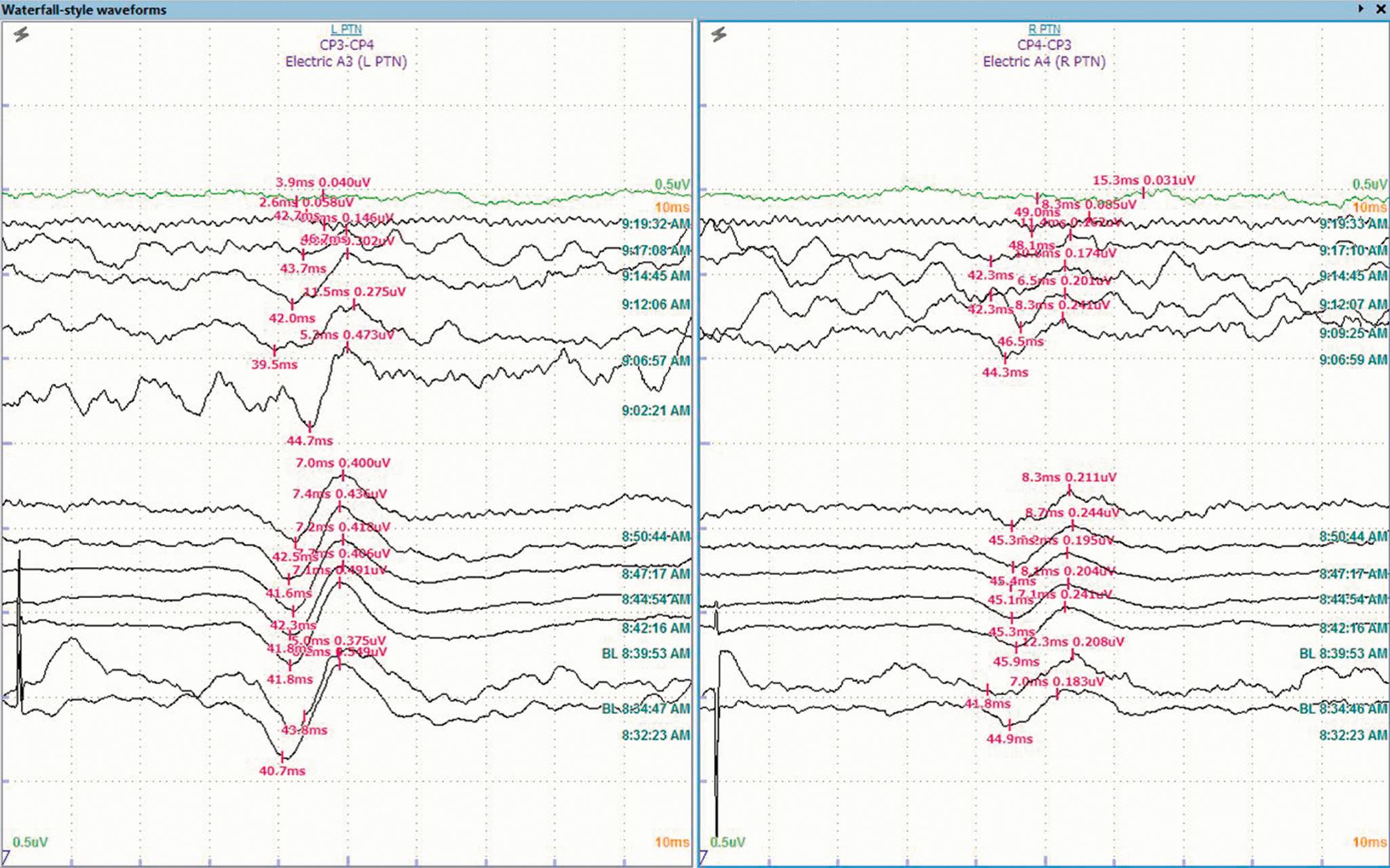 Fig. 83.2, A series of cortical responses from stimulation of the left and right posterior tibial nerves ( L PTN and R PTN ). The “waterfall” configuration shows a deterioration of the cortical potential (P37) at around 9:06 am . This change worsens over the course of 10 minutes until the cortical responses are lost around 9:17 am .