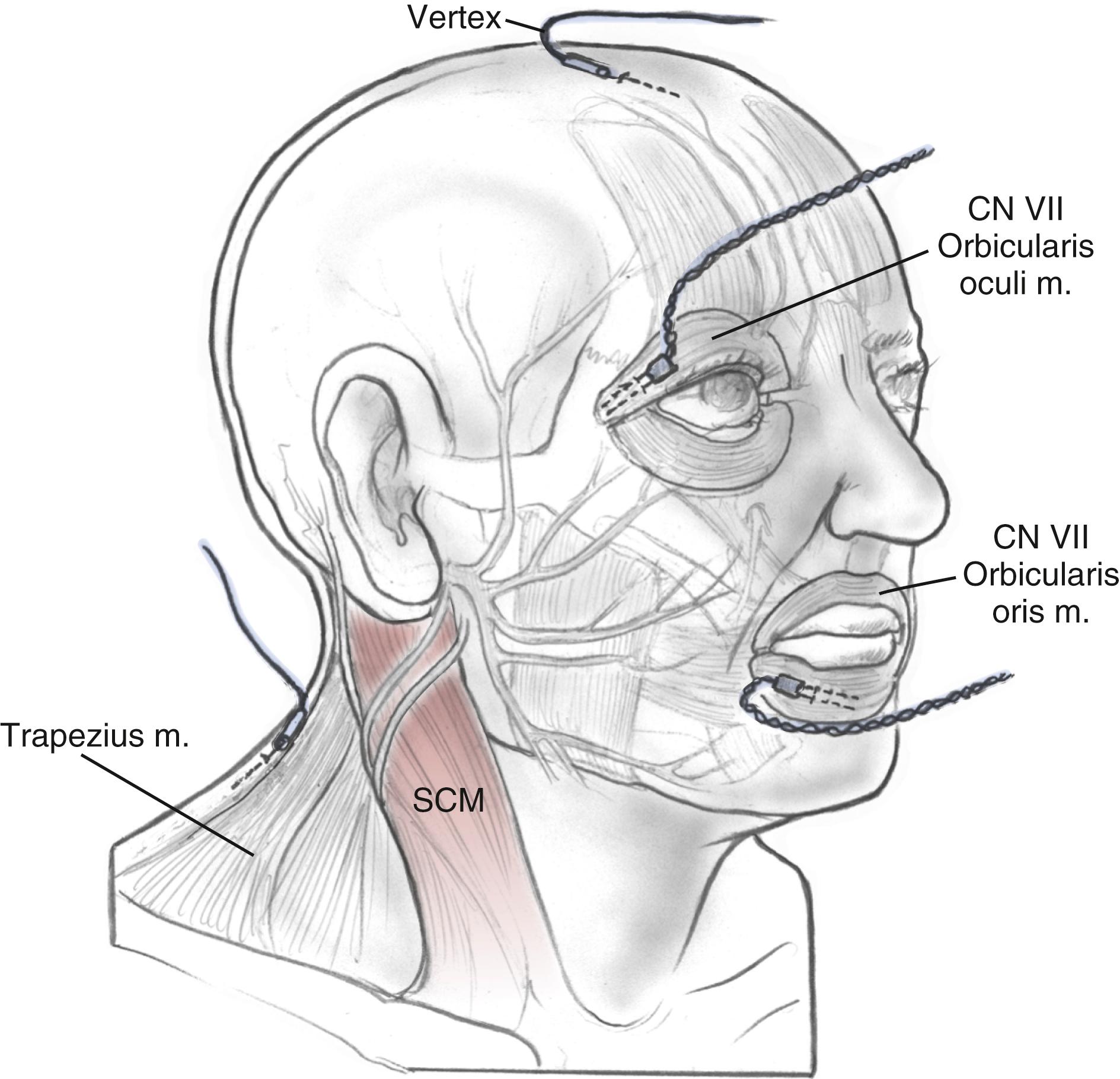 Fig. 58.1, Electrode placement for facial nerve intraoperative monitoring. SCM, Sternocleidomastoid.