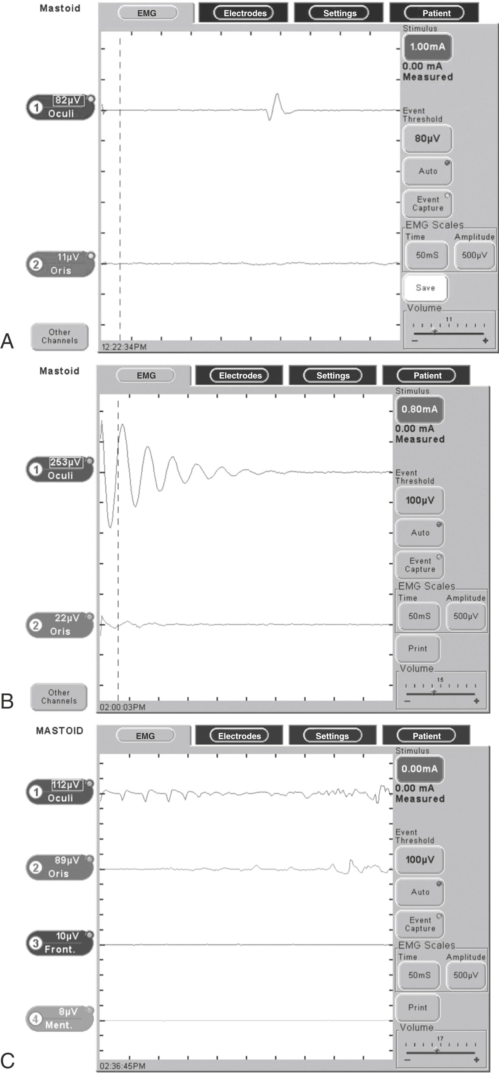 Fig. 58.2, Facial nerve monitor screen (Nerve Integrity Monitor [NIM] Response 2.0; Medtronic ENT). Two-channel modes are typical for mastoid surgery. (A) Burst activity, occurring with mechanical stimulation or brief electric stimulation. (B) Pulsatile stimulus. (C) Train activity.