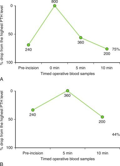 Fig. 59.3, A, The increase in parathyroid hormone (PTH) level at the 0-minute sample as a result of manipulation during parathyroid gland dissection. B, An apparent insufficient PTH drop if the 0-minute sample was not collected during the parathyroidectomy of this same patient.