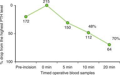 Fig. 59.5, The intraoperative parathyroid hormone (PTH) dynamic of a patient in whom the PTH level does not drop sufficiently in 10 minutes after excision of a suspicious gland; however, sample collection in 20 minutes meets the criteria correctly predicting operative success.