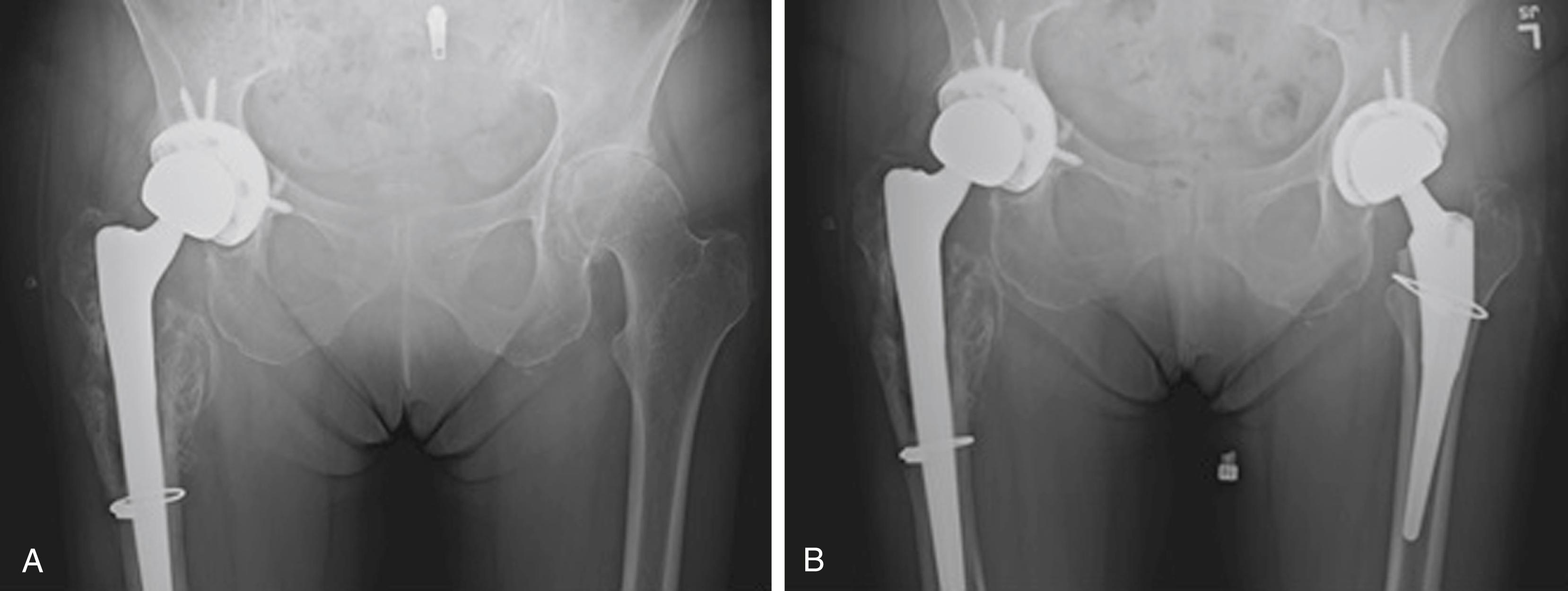 Fig. 21.2, Preoperative (A) and postoperative (B) radiographs of a 78-year-old female who underwent a total hip arthroplasty. Intraoperatively, a calcar fracture was noted during stem insertion, the stem was removed, a cable was placed, and the stem was reinserted. The patient was allowed to weight bear as tolerated and did well postoperatively.