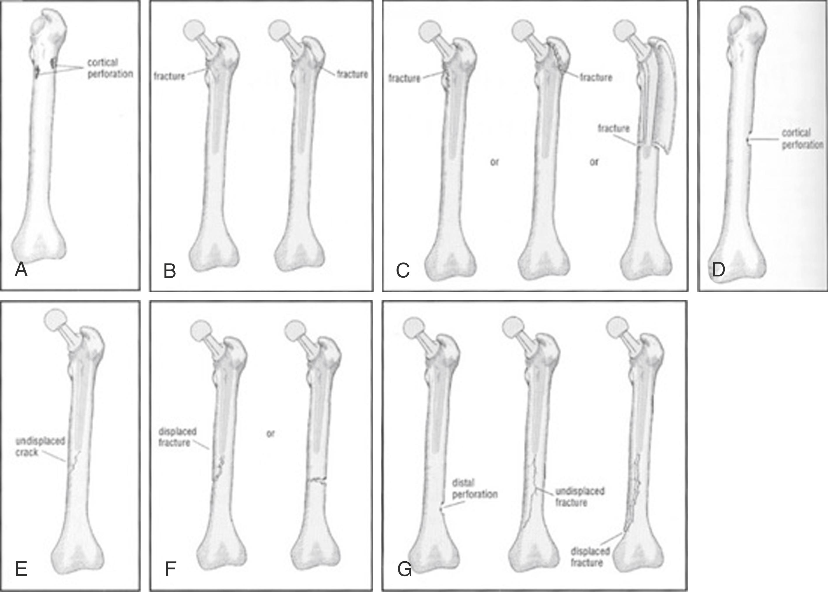 Fig. 21.1, Vancouver Classification System for intraoperative periprosthetic femur fractures.