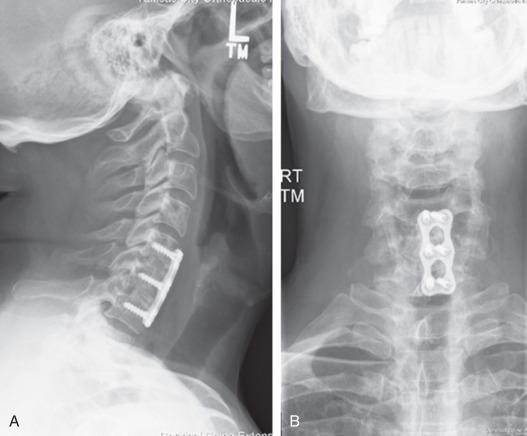 FIG. 95.1, Lateral (A) and anteroposterior (B) radiographs depicting two-level instrumented anterior cervical discectomy and fusion through the standard Smith-Robinson approach.