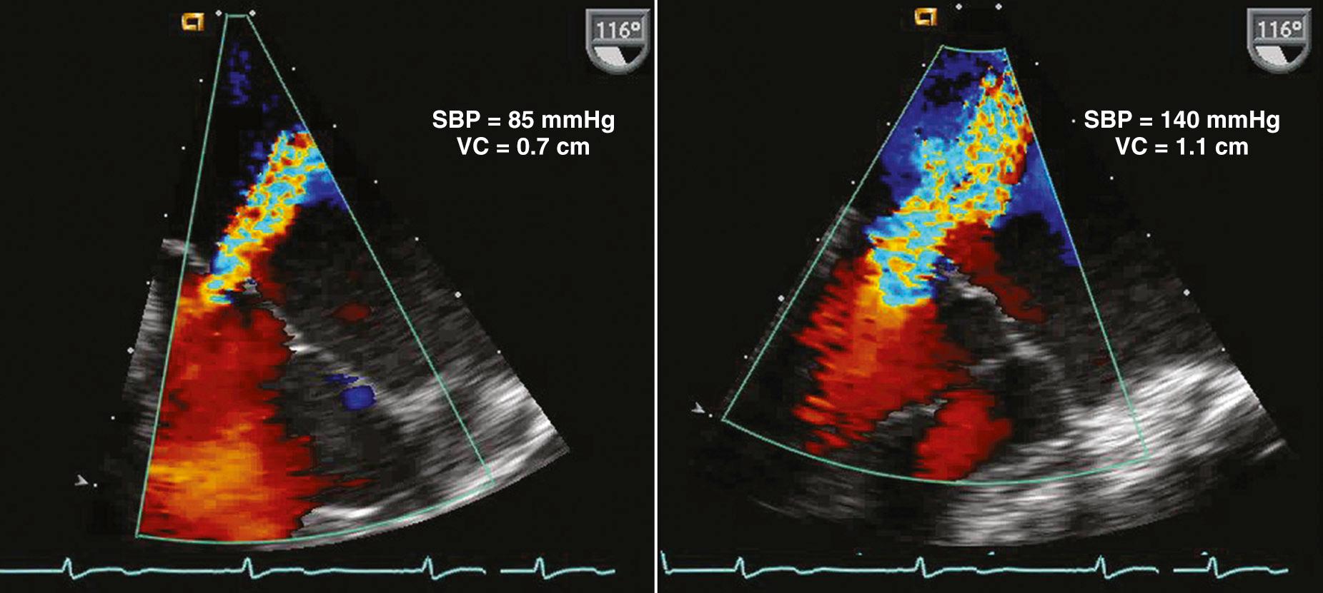 Fig. 18.2, Effect of loading conditions on mitral regurgitant severity.