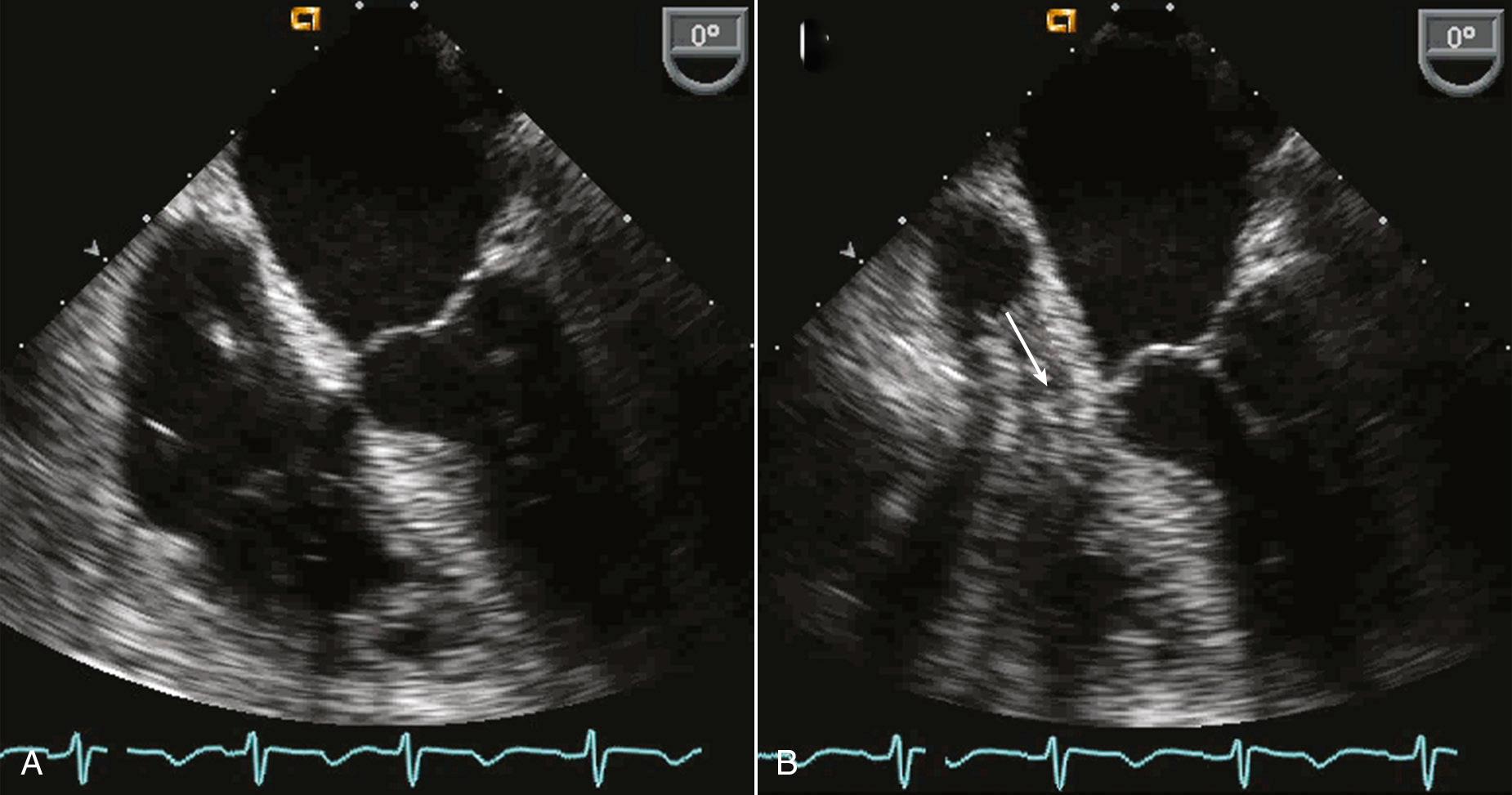 Fig. 18.3, External cardiac compression on intraoperative transesophageal echocardiography.