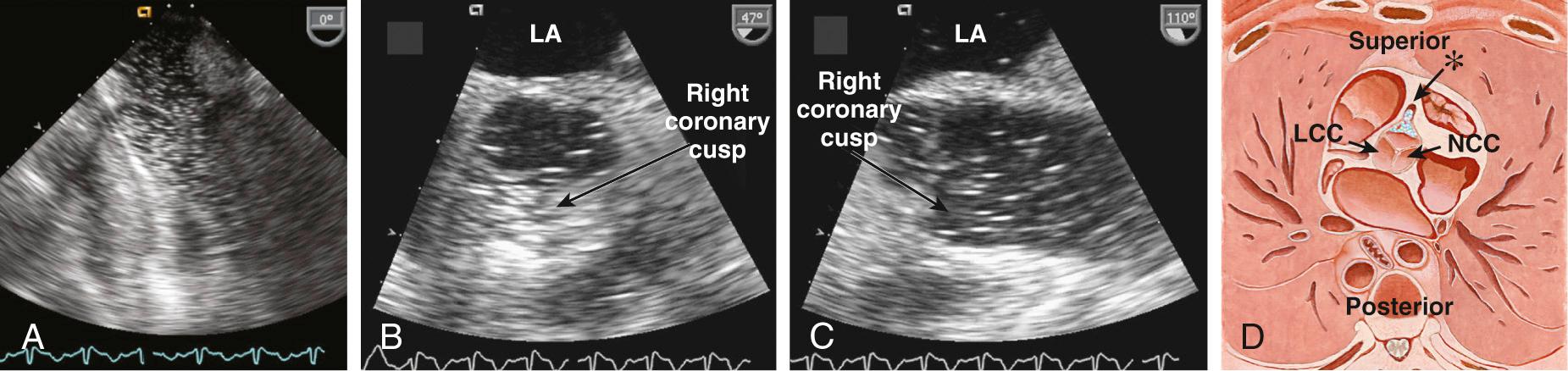 Fig. 18.4, Air emboli: right coronary artery.