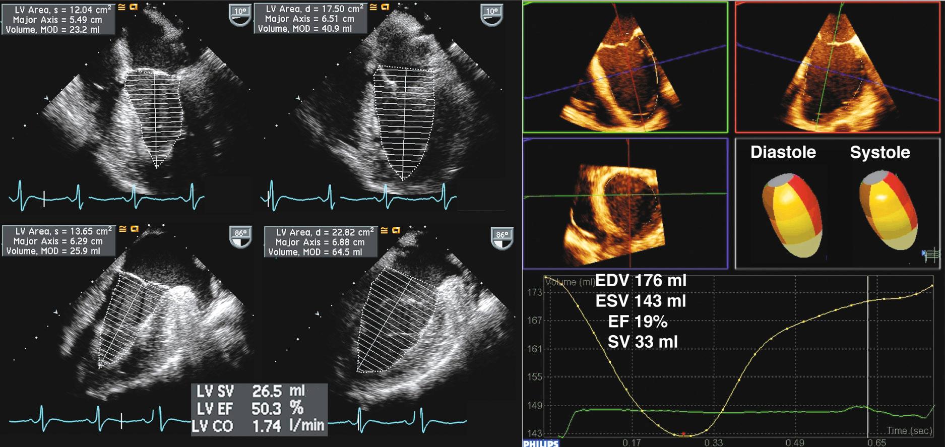 Fig. 18.5, 2D and 3D transesophageal echocardiography calculation of ejection fraction.