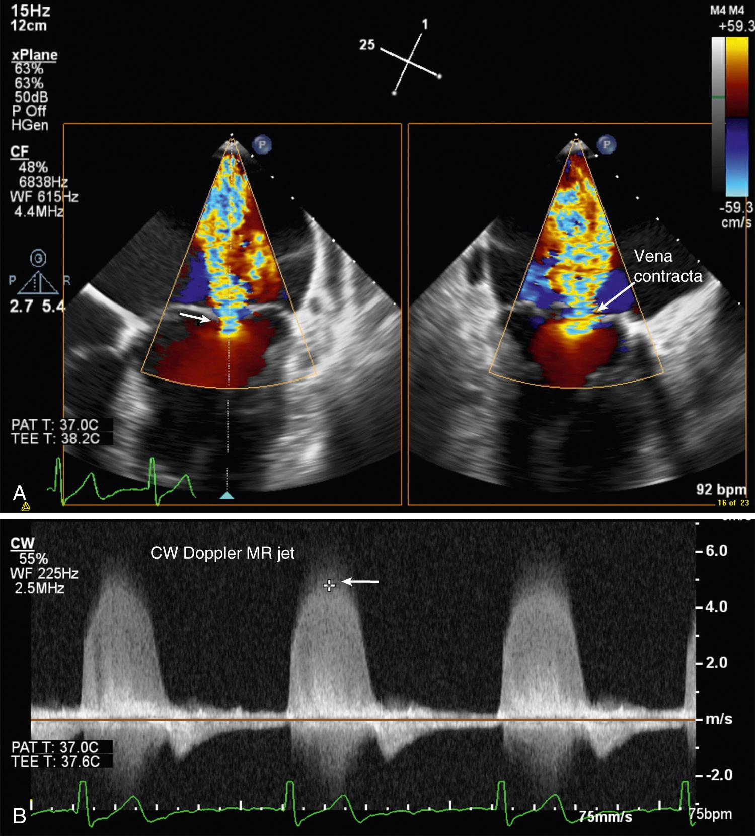 Fig. 18.8, Transesophageal echocardiography quantitation of mitral regurgitation.