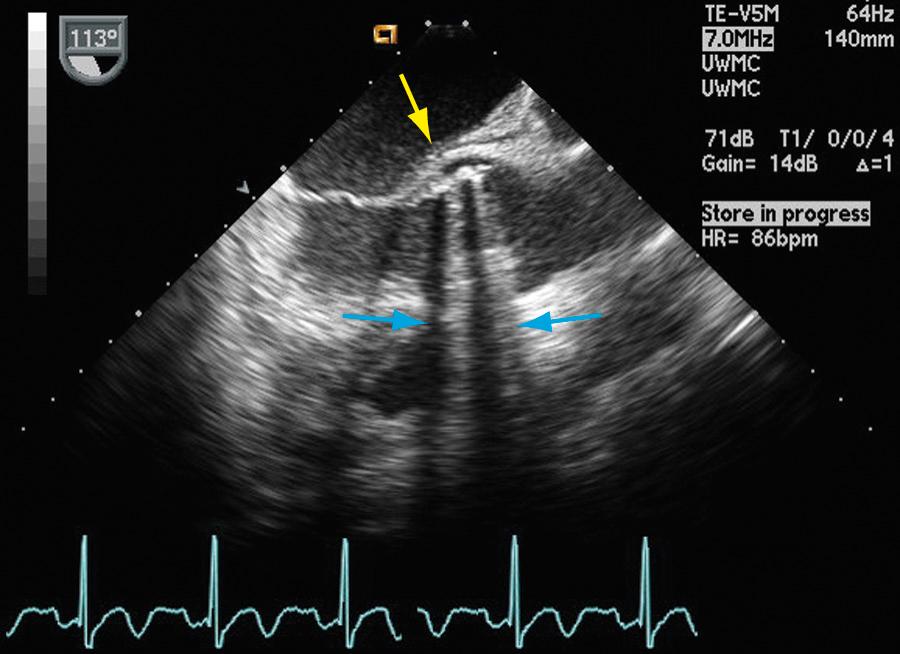 Fig. 18.9, Shadowing and reverberations on transesophageal echocardiography.