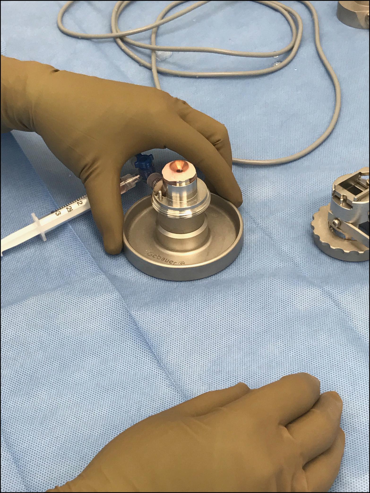 Fig. 133.1, A photograph showing the donor cornea on an artificial chamber maintainer prior to placement of the microkeratome for Descemet stripping automated endothelial keratoplasty donor tissue preparation.