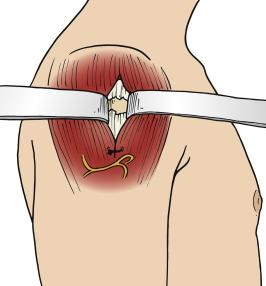 • Fig. 31.1, Artistic representation of the axillary nerve coursing 5 cm distal to the lateral border of the acromion, with the presence of a stay suture in the deltoid to prevent excessive splitting of the muscle.