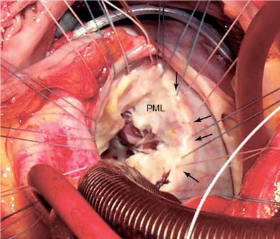 Fig. 22.1, Surgical Exposure of the Mitral Valve.