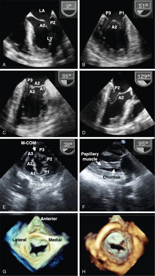 Fig. 22.4, Basic TEE Views of the Mitral Valve (MV).