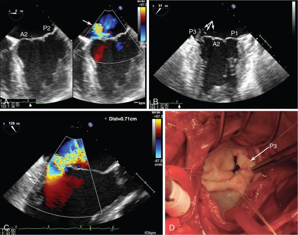 Fig. 22.5, Anteriorly Directed Mitral Regurgitant Jet.