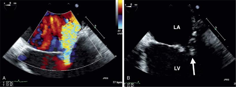 Fig. 22.6, Ischemic (Secondary) Mitral Regurgitation (Video 22.6 ).