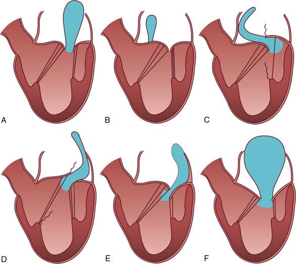 Fig. 22.7, Carpentier’s Classification of Mitral Regurgitation Based on Leaflet Motion.