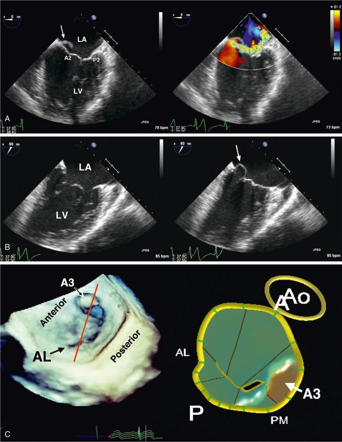 Fig. 22.8, Anterior Leaflet Partial Flail.