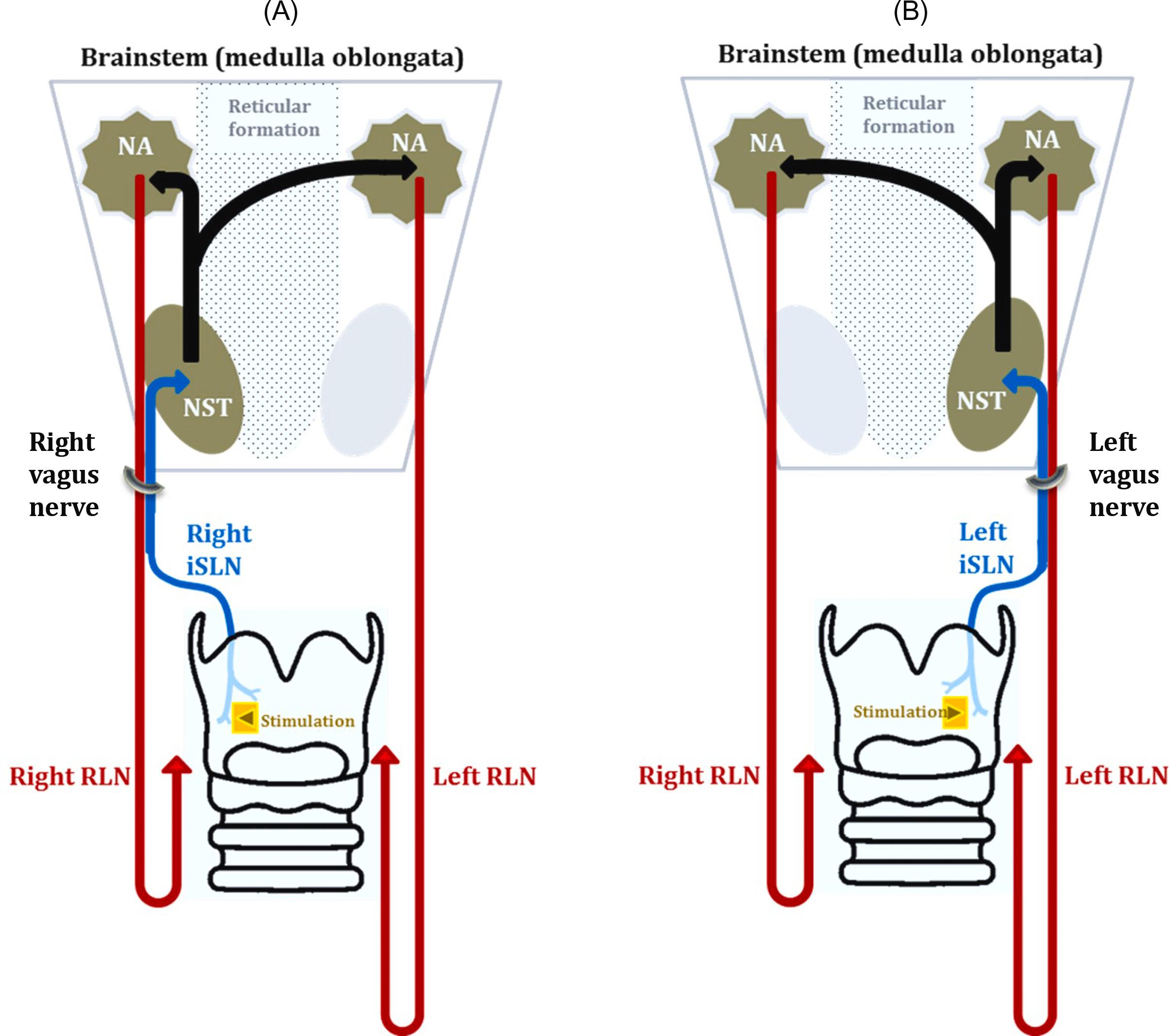 Figure 15.1, The laryngeal reflex arc for glottis adduction (LAR) divided into two different schemas according to right (A) and left (B) afferent information from the right and left laryngeal mucosa, respectively. The LAR is a protective reflex of the upper airway physiologically triggered by mechanical or chemical irritation of the supraglottis mucosa. For the LAR to effectively prevent aspiration, it must result in simultaneous bilateral vocal fold adduction, provided the reflex arc is intact. Hence, regardless if the laryngeal mucosa is irritated uni- or bilaterally, the LAR always results in bilateral activation of adductor laryngeal muscles. Similarly, electrical stimuli applied to one side of the laryngeal mucosa (current methodology) will result in bilateral closure of the glottis (Videos 15.1 (normal speed) and 15.2 (slow-motion) – (supplementary material on the web)). Sensory information from the laryngeal mucosa travels through the internal branch of the superior laryngeal nerve (iSLN) and vagus nerve to the nucleus of the solitary tract (NST). From here, fibers project to the ipsi- and contralateral nucleus ambiguous (NA) where the motor neurons are located. Efferent motor neurons from the NA travel to the larynx via the vagus nerve and its recurrent laryngeal (RLN) branch to the laryngeal musculature, producing laryngeal inlet closure and airway protection.