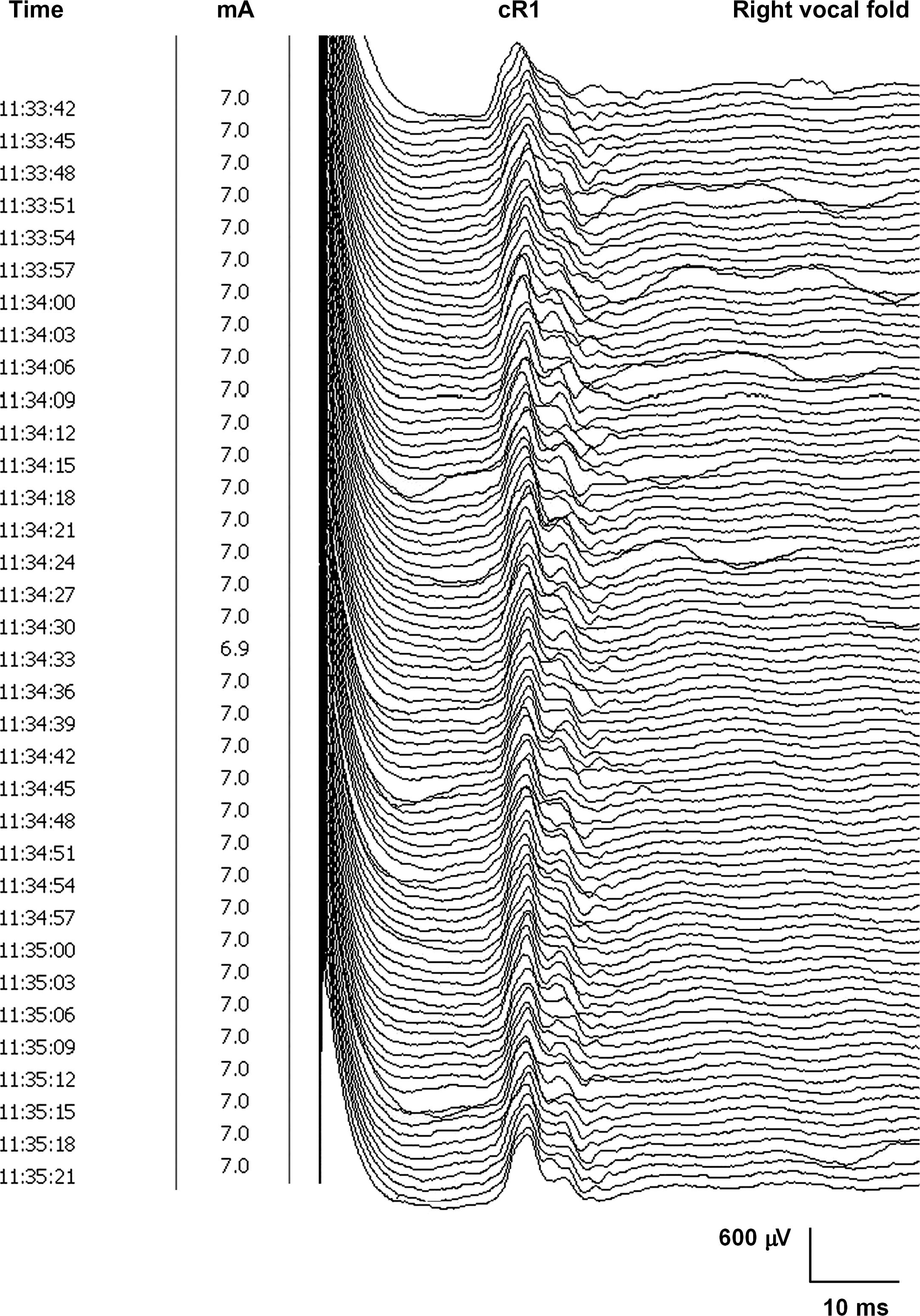 Figure 15.4, Continuously repeated stimulation of the laryngeal mucosa, at 0.7–1 Hz repetition rate, for more than 90 s, does not show habituation phenomena of the cR1 component of the laryngeal adductor reflex.