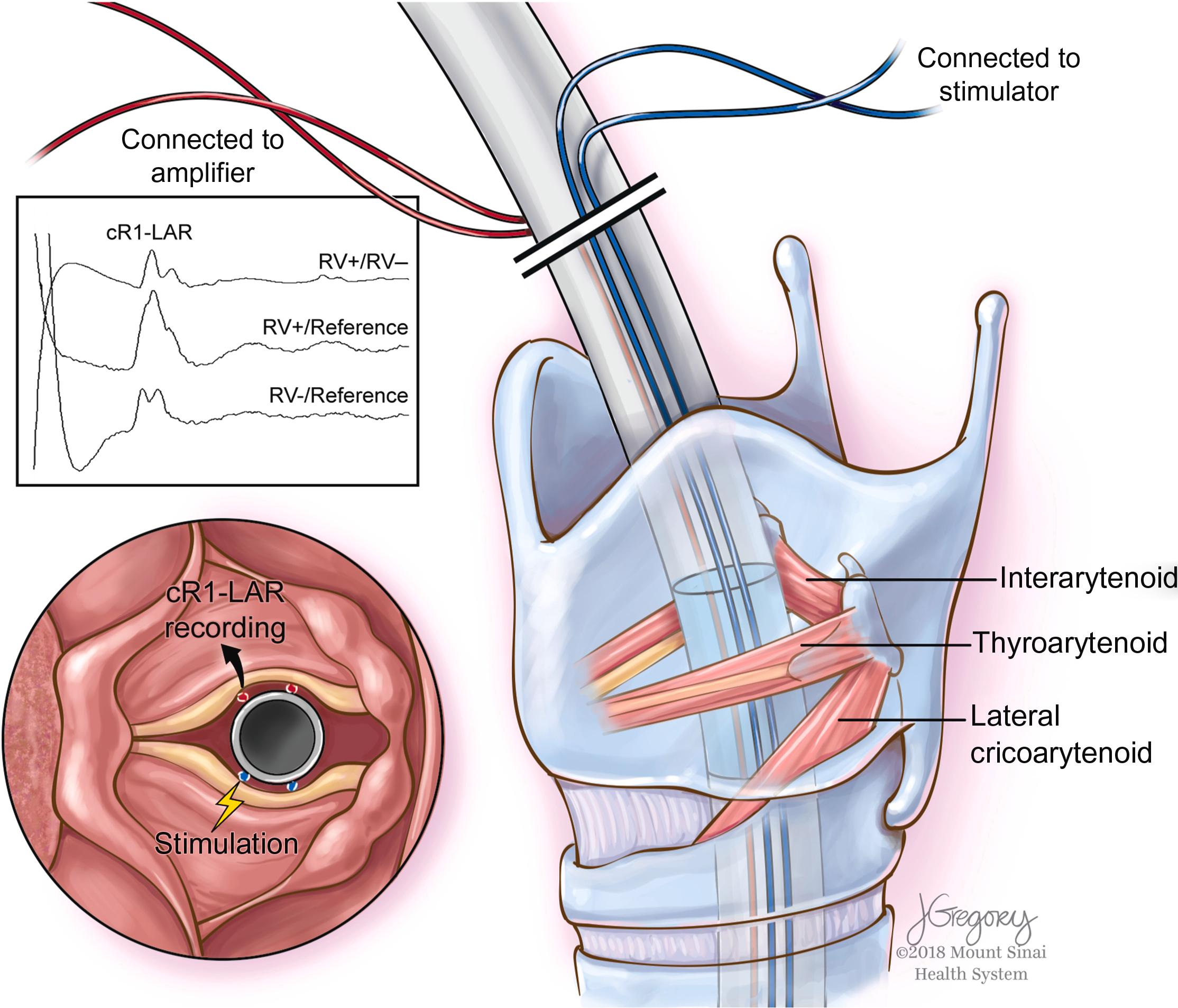 Figure 15.5, Illustration of the methodology for eliciting the laryngeal adductor reflex (LAR) by using an endotracheal tube containing right and left surface electrodes for stimulating and recording. These electrodes come into direct contact with the right and left vocal folds. Electrical stimulation of the laryngeal mucosa on the left side ( blue ) elicits the LAR. The electrodes on the right side ( red ) are used to record the cR1 component of the LAR. The elicited cR1 is recorded using three different montages ( upper left square ). In this example, the cR1 represents the electrical activity of muscles involved in adduction of the right vocal fold. The RV+/RV− array refers to the two electrodes in contact with the right vocal fold and the reference is a subcutaneous needle placed at the sternum.