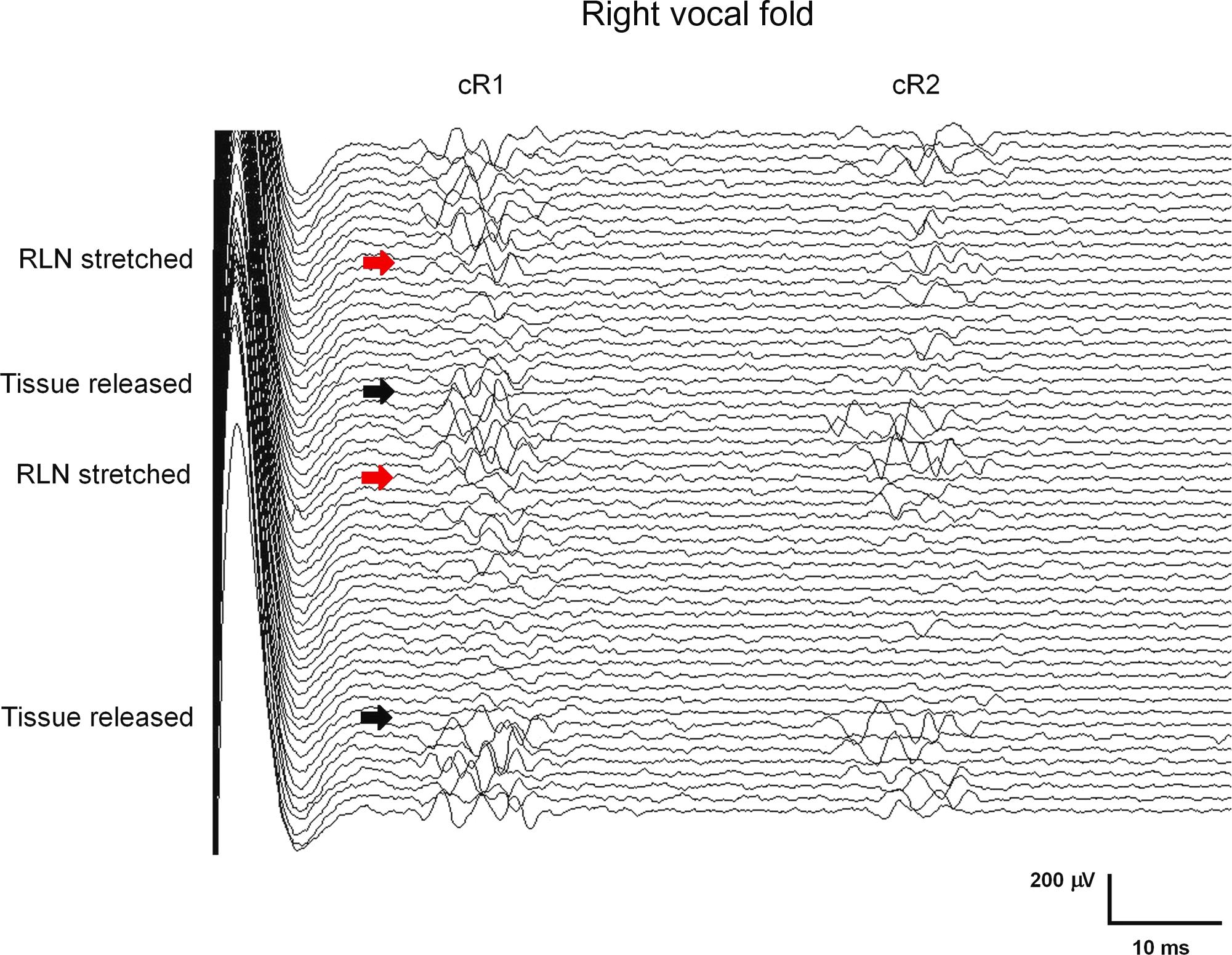 Figure 15.6, Consecutive traces of the contralateral R1 (cR1) and R2 (cR2) components of the laryngeal adductor reflex (LAR) recorded from the right vocal fold to left laryngeal mucosa stimulation. Maneuvers that put stretch directly on the recurrent laryngeal (RLN) temporally decreased the amplitude of cR1 and cR2 components of the LAR. The amplitude of both components recovered by simply relaxing the tissue.