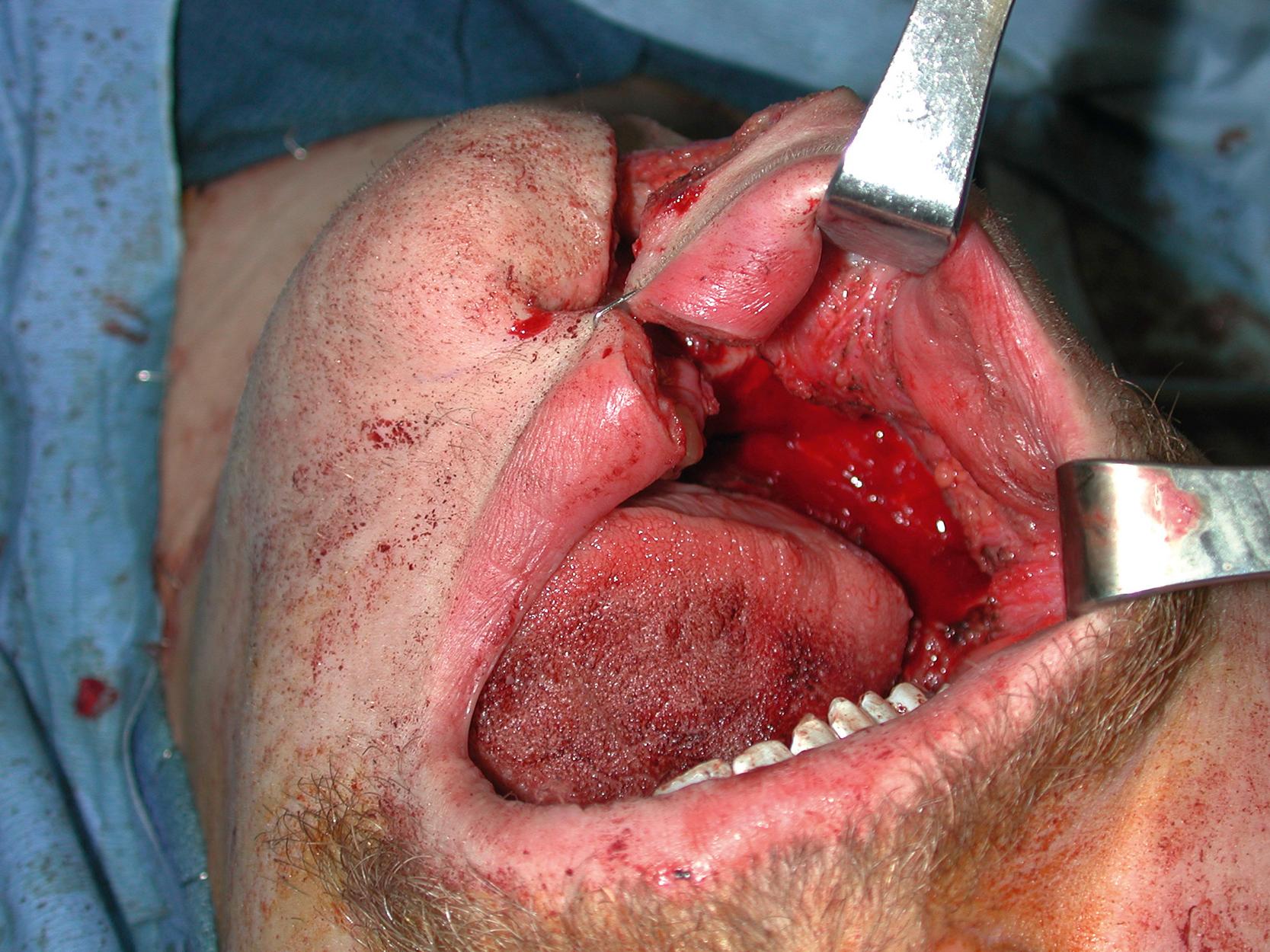 Fig. 4.2, Intraoperative view showing the intraoral soft tissue defect after excision for the alveolar edge and floor of the mouth squamous cell carcinoma.