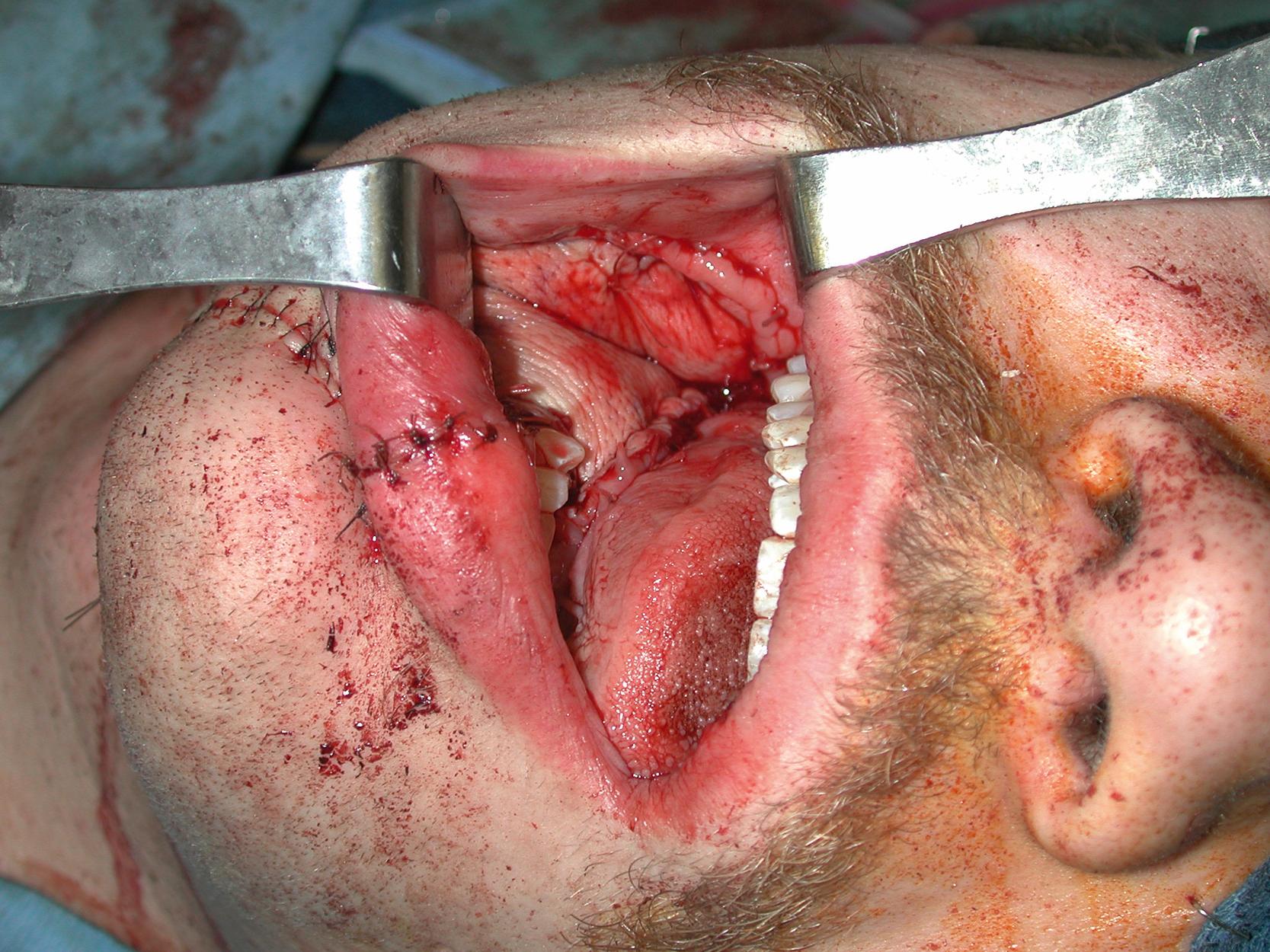 Fig. 4.5, Intraoperative view showing completion of the intraoral inset of the free radial forearm flap. A water-tight closure of the skin paddle was demonstrated.