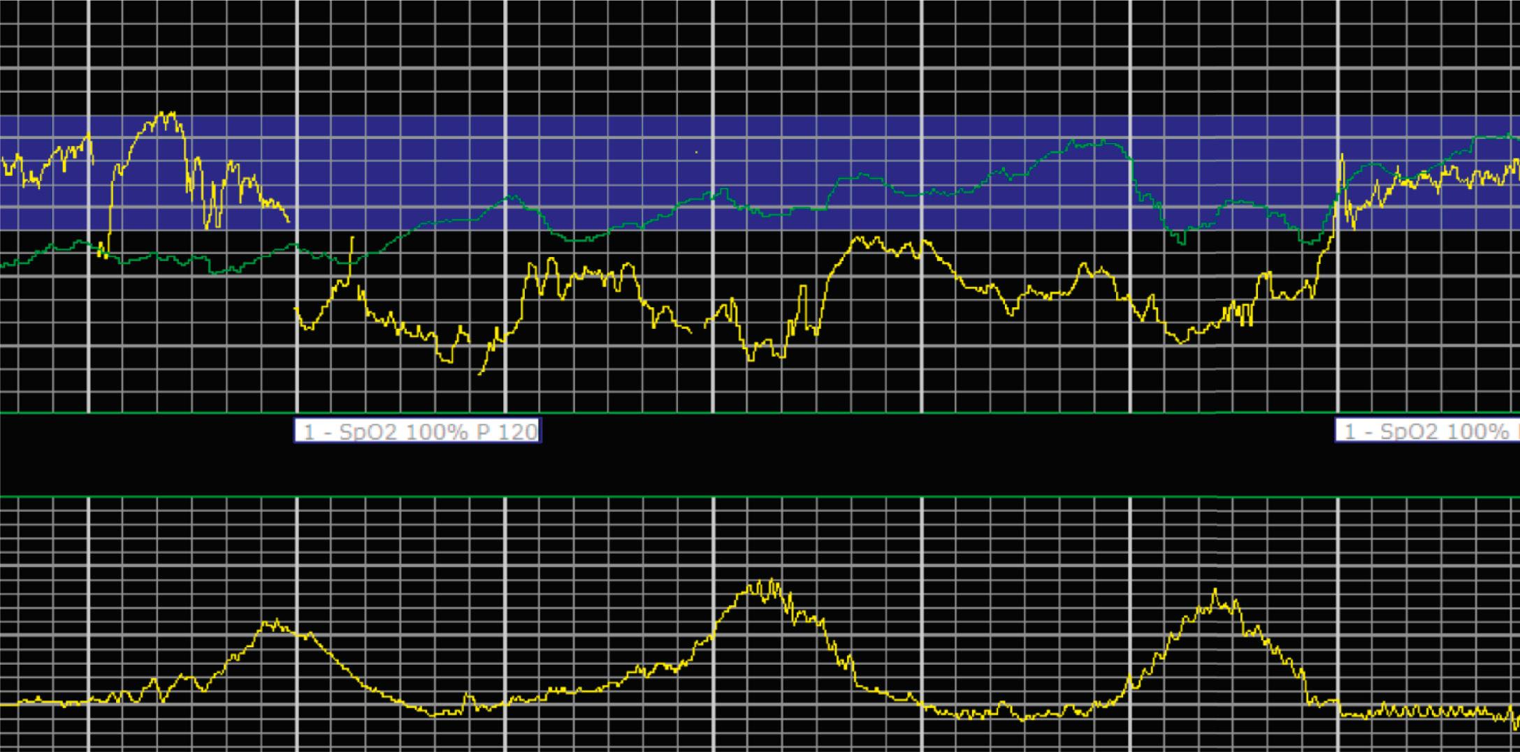 Fig. 15.14, Prolonged Deceleration.