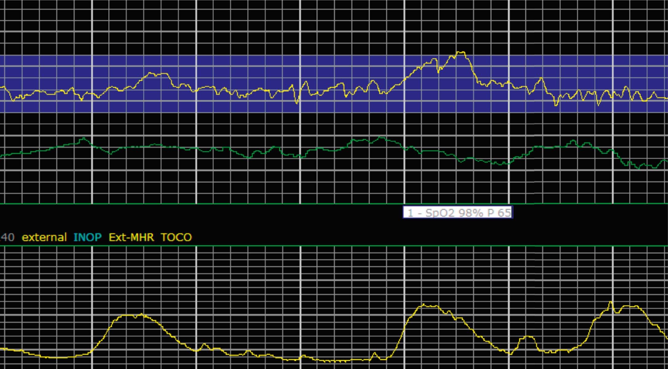 Fig. 15.16, Category I With Acceleration.