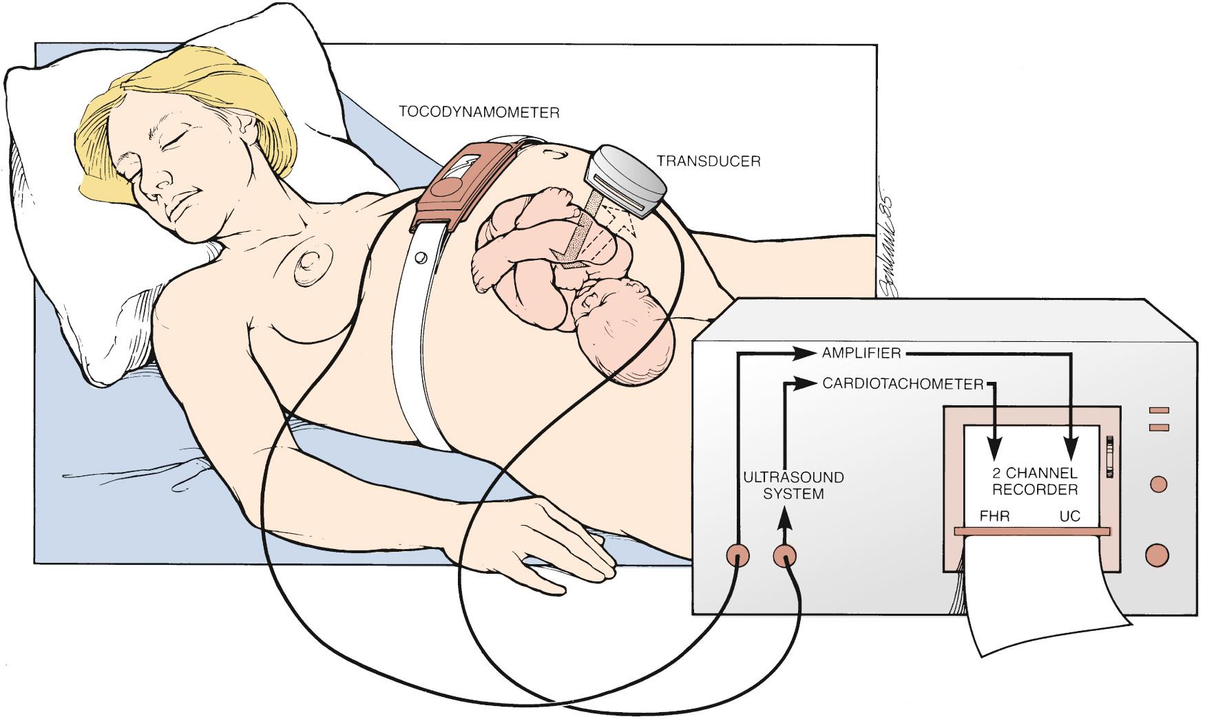 Fig. 15.2, Instrumentation for External Monitoring.