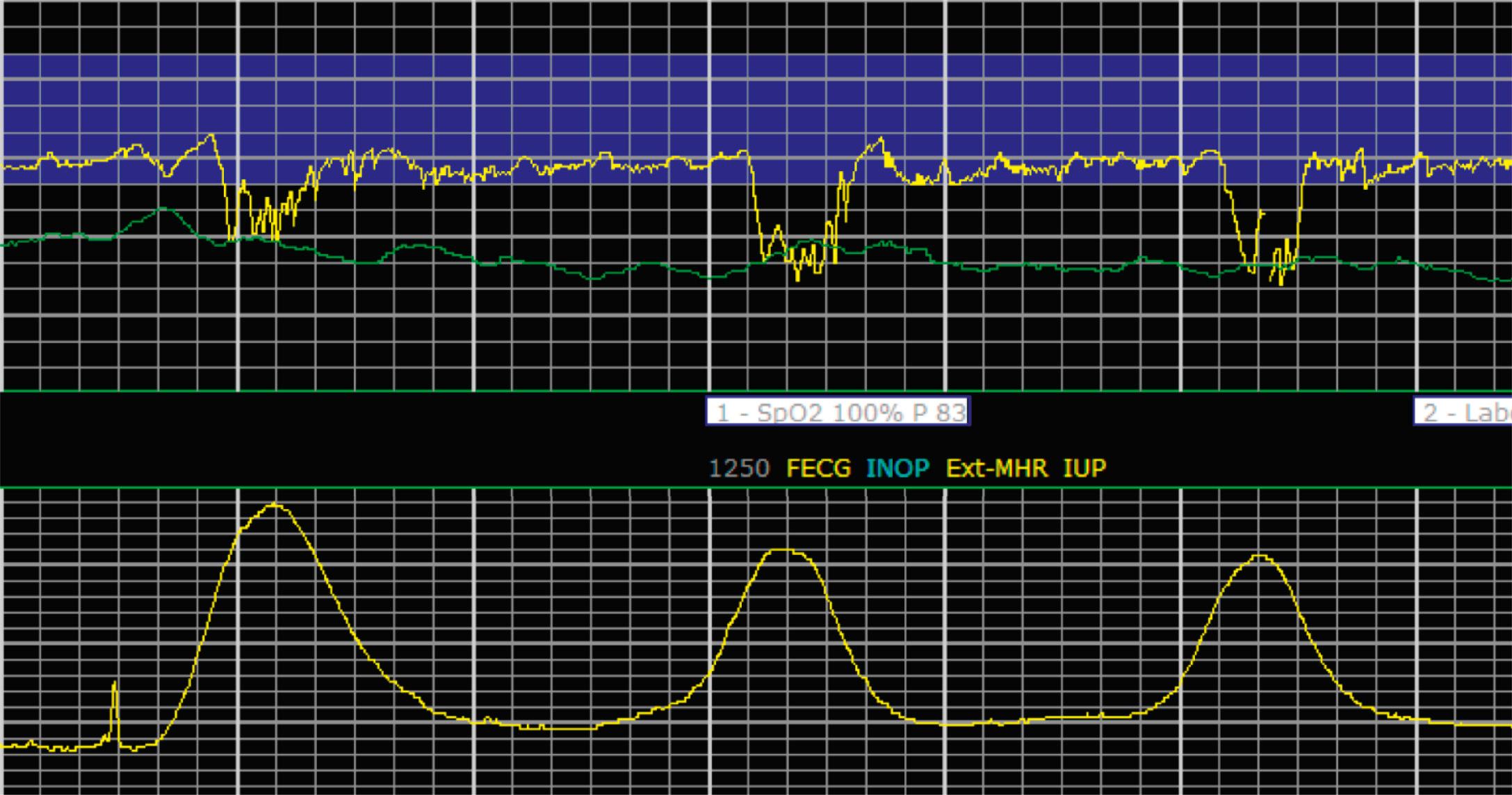 Fig. 15.23, Category II 4.