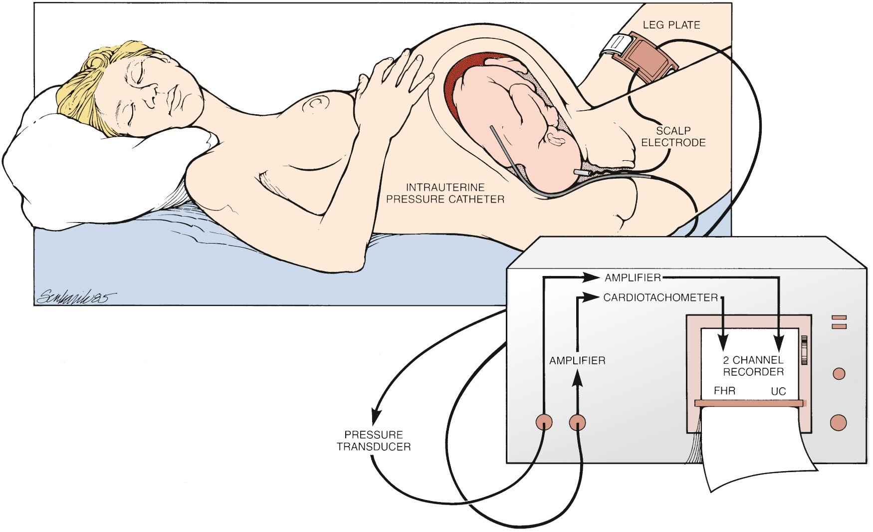 Fig. 15.3, Techniques Used for the Direct Monitoring of Fetal Heart Rate (FHR) and Uterine Contractions (UCs) .