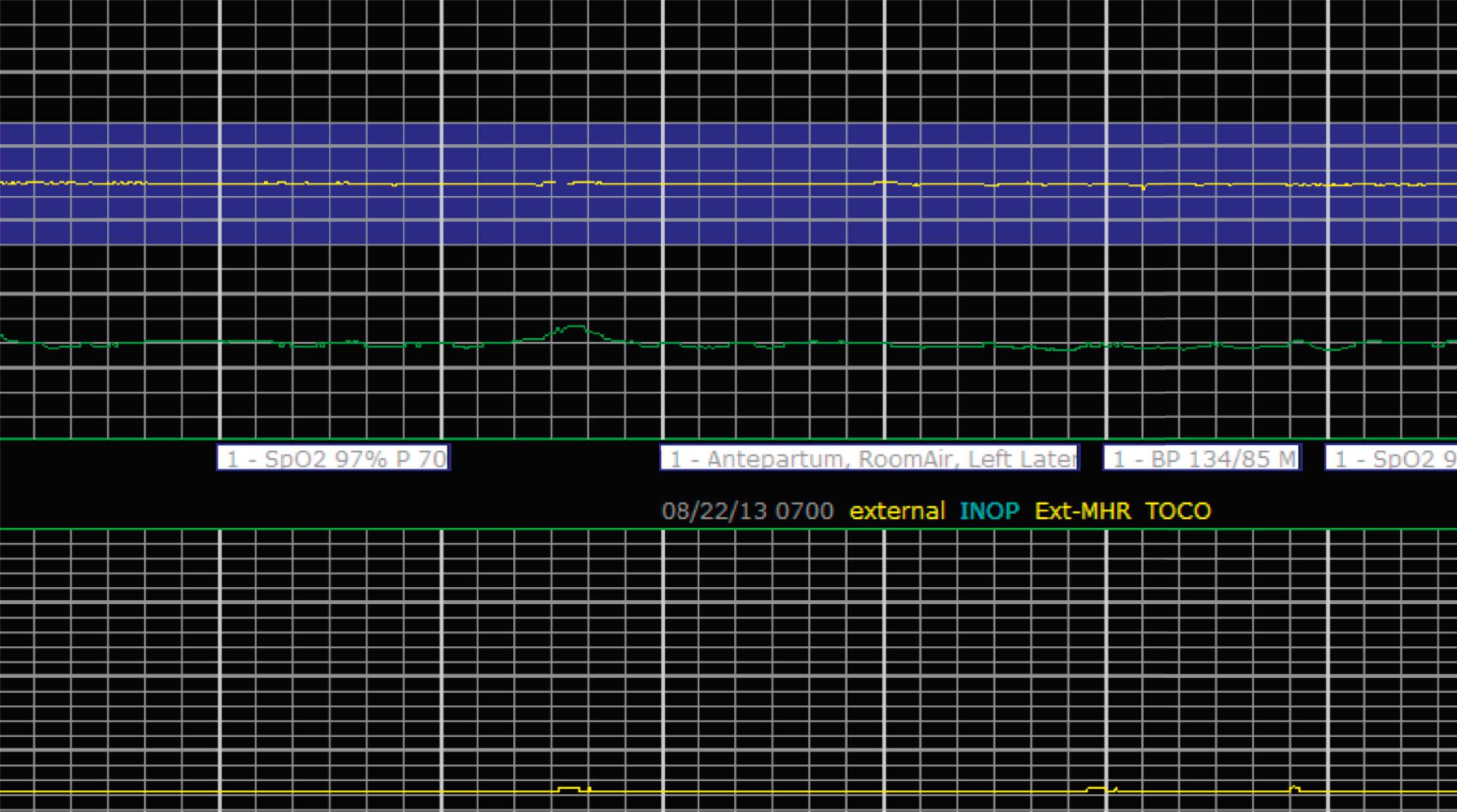 Fig. 15.4, Absent Variability.