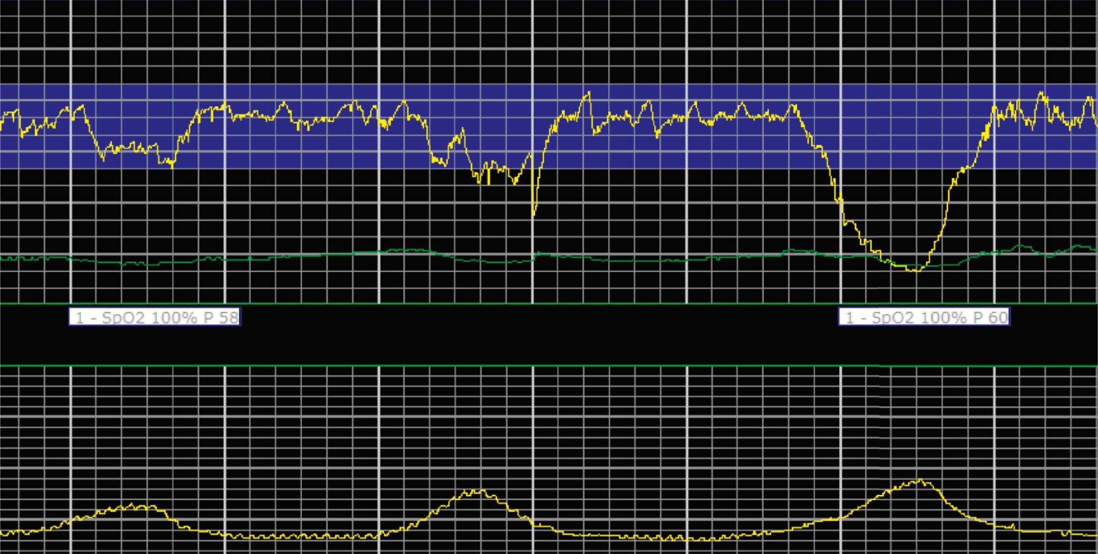 Fig. 15.6, Moderate Variability.