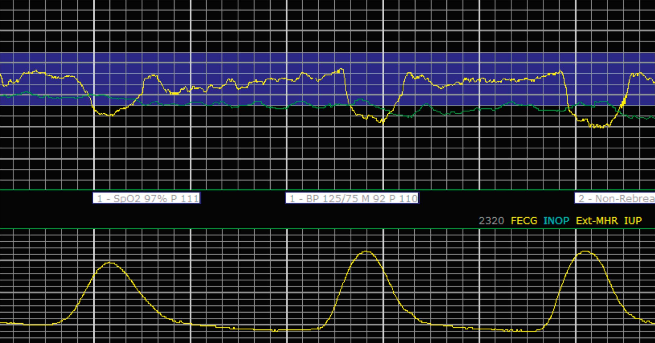 Fig. 15.10, Variable Decelerations.