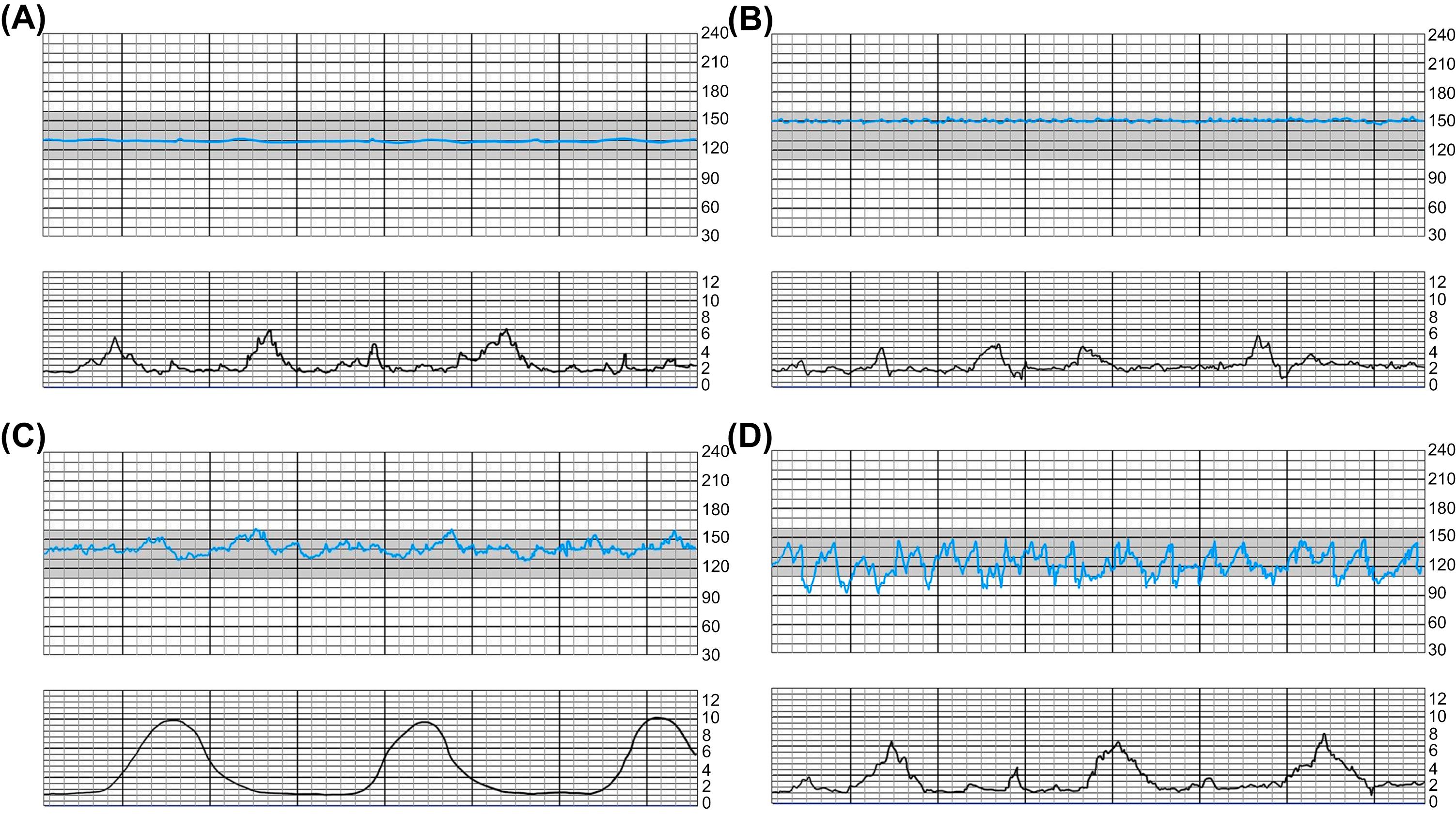 Fig. 8.1, Examples of (A) absent, (B) minimal, (C) moderate, and (D) marked variability.