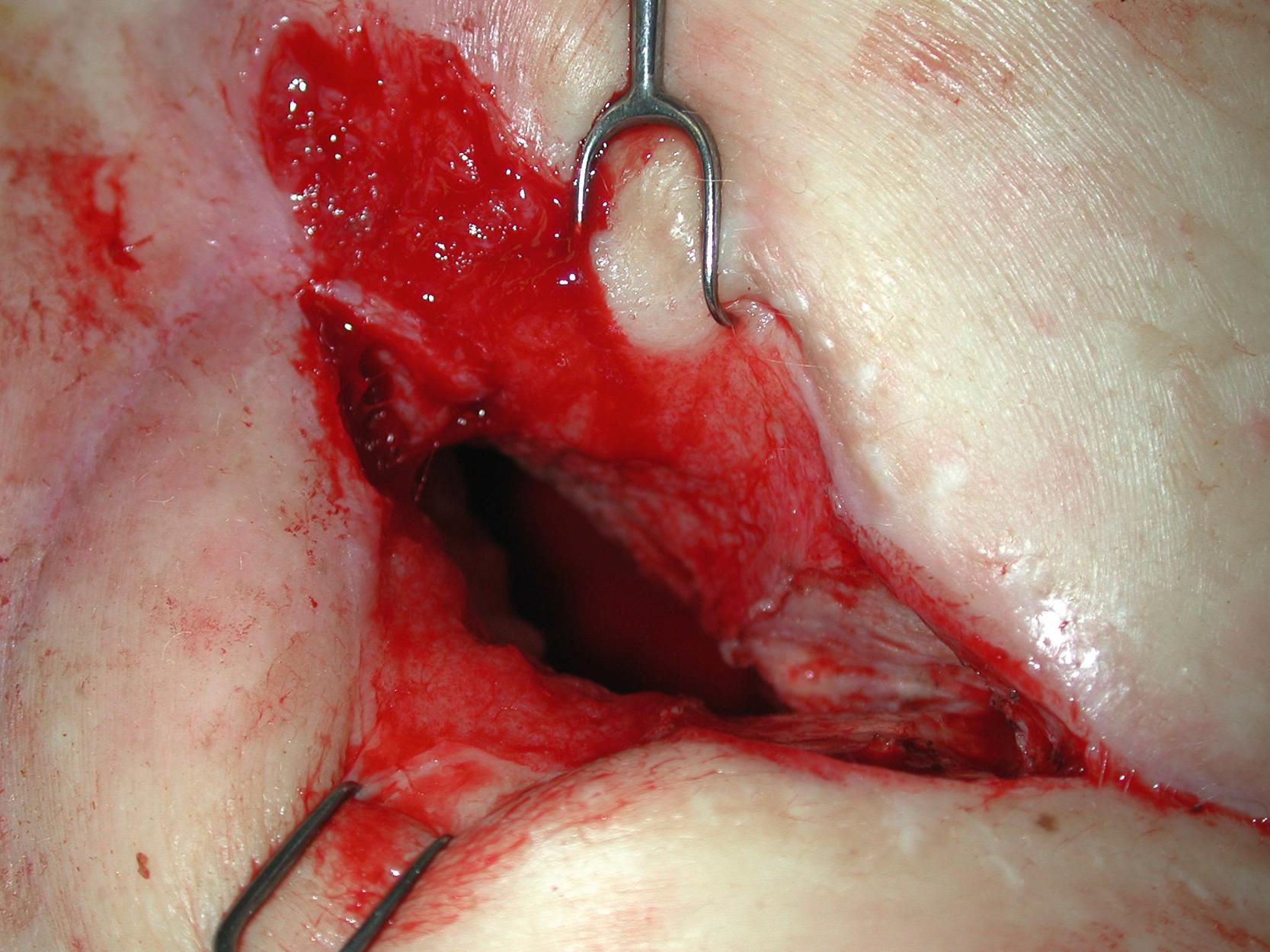 Fig. 24.9, Intraoperative view showing the recurrent bronchopleural fistula and open chest wound.
