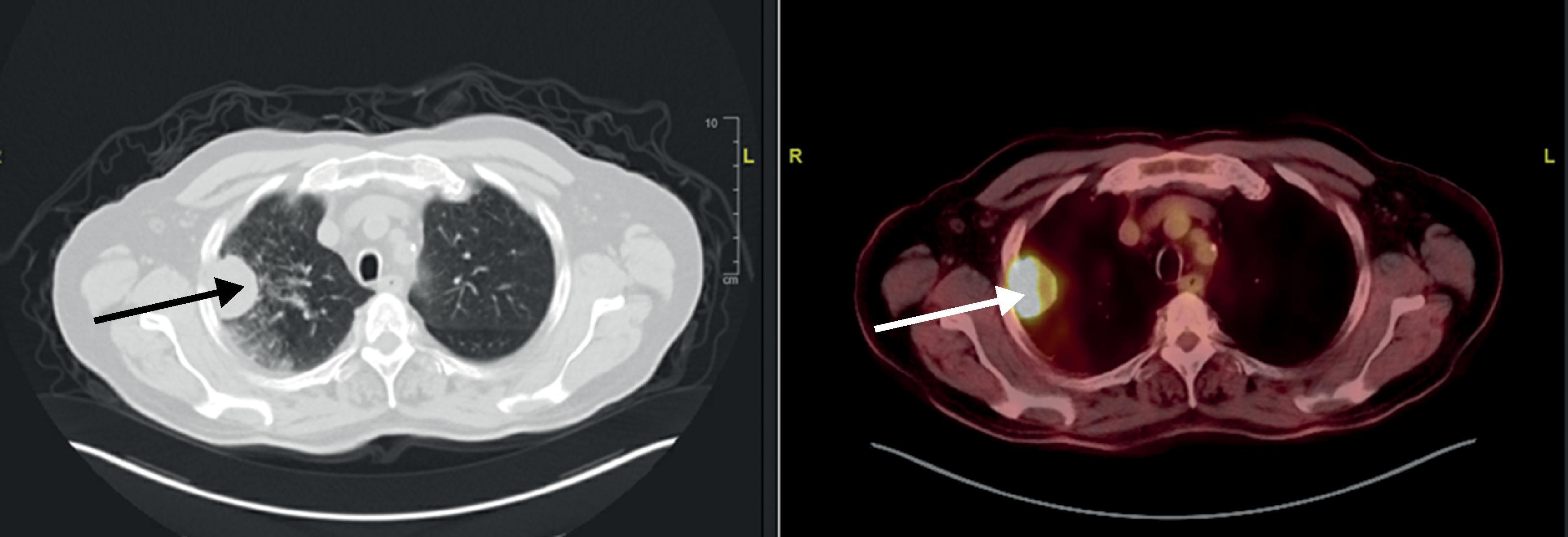 • Fig. 4.3, A CT scan of a 73 years-old male (left) with hypermetabolic 4.2 cm right upper lobe on PET scan (right). Chest wall invasion was noted, and he underwent right upper lobectomy with chest wall resection and reconstruction. Pathology was a 7-cm T3N0 pleomorphic carcinoma.