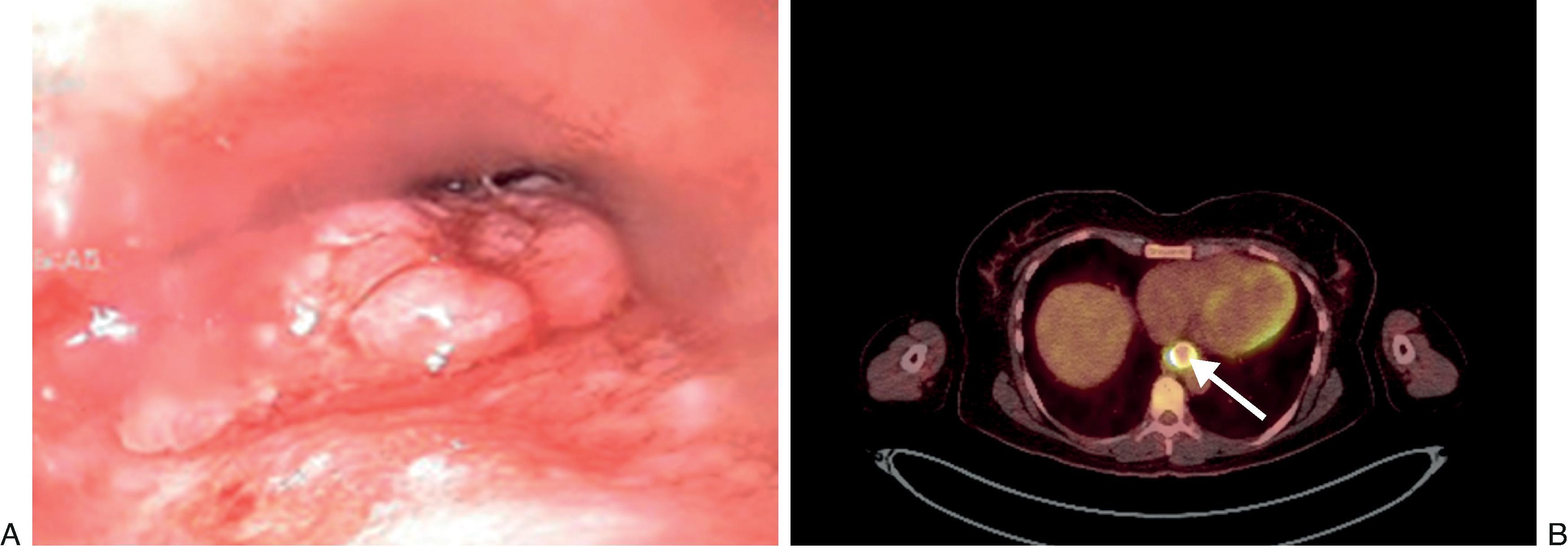 • Fig. 4.4, A 35-year-old female diagnosed with a lower esophageal clinical T2N0 adenocarcinoma. She underwent hybrid Ivor-Lewis esophagectomy. Pathology was pT3N2 adenocarcinoma. She subsequently underwent adjuvant chemoradiation ( A and B ). B , PET scan image.