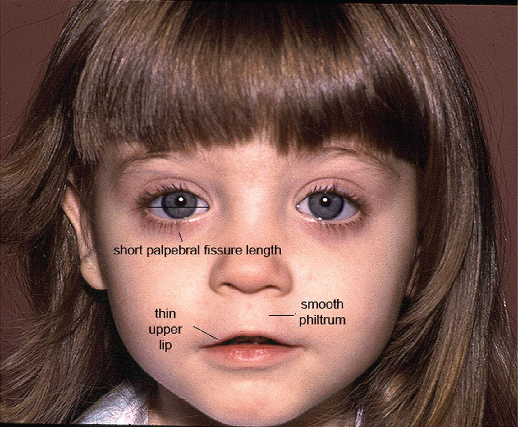 Fig. 11.2, Child with three diagnostic facial features of fetal alcohol syndrome.