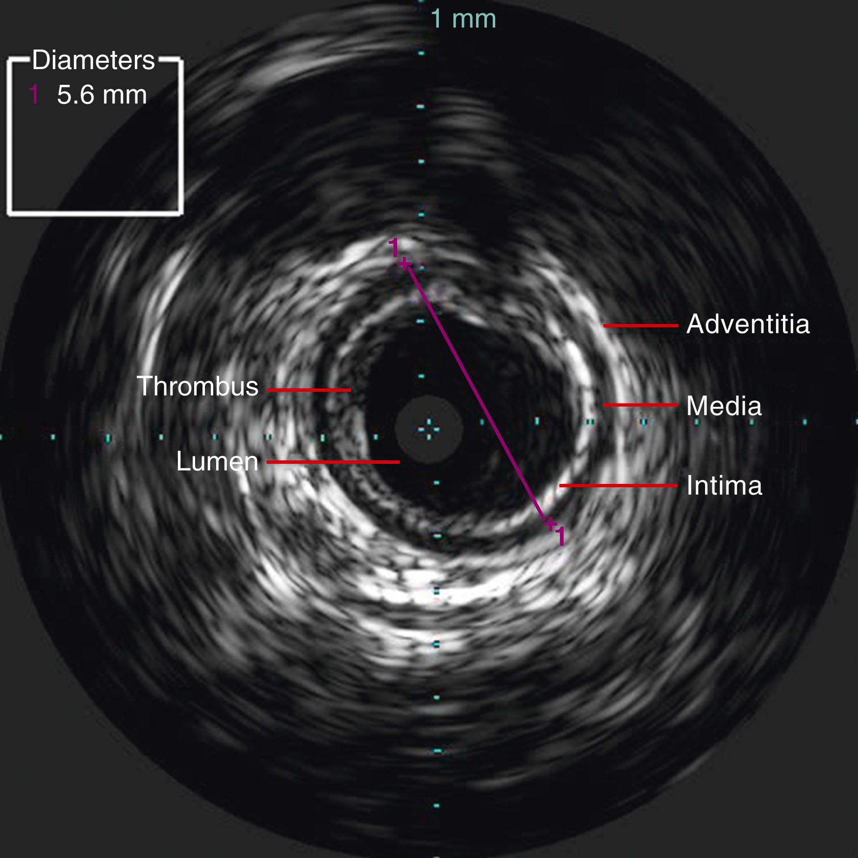 Figure 32.2, In gray scale, the layers of the arterial wall are visualized clearly, with the intima and adventitia appearing bright and echogenic, while the media is darker and echolucent. The blood-filled lumen appears very dark, with the clear demarcation between the arterial wall and the lumen allowing measurements to be obtained.