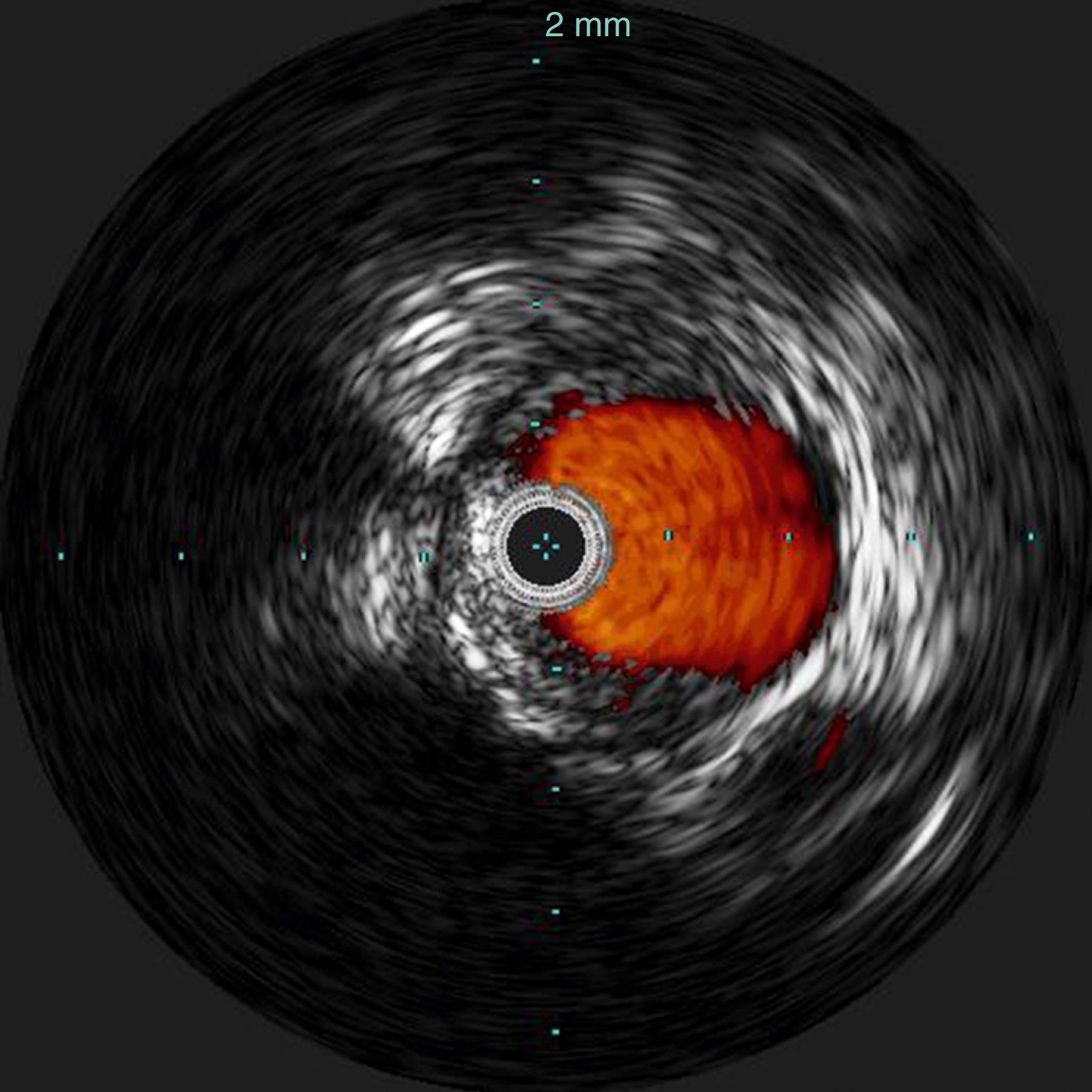 Figure 32.3, Color-Flow Intravascular Ultrasound.