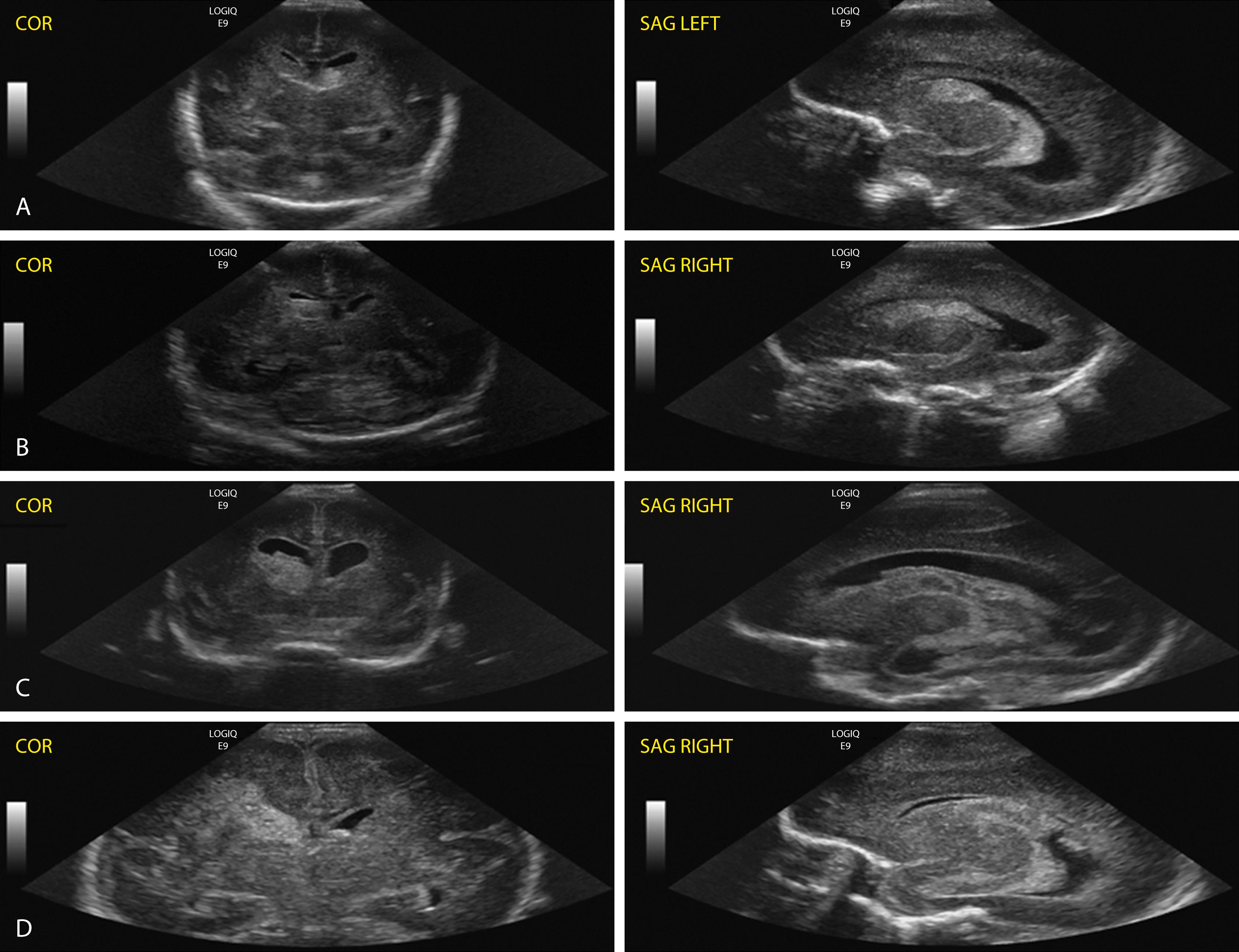 Fig. 131.4, Grading of the severity of germinal matrix hemorrhage–intraventricular hemorrhage (IVH). Coronal (COR) and parasagittal (SAG) ultrasound scans: (A) germinal matrix hemorrhage, grade I; (B) IVH (filling <50% of the ventricular area), grade II; (C) IVH with ventricular dilatation, grade III; (D) large IVH with associated parenchymal echogenicity (hemorrhagic infarct), grade IV.