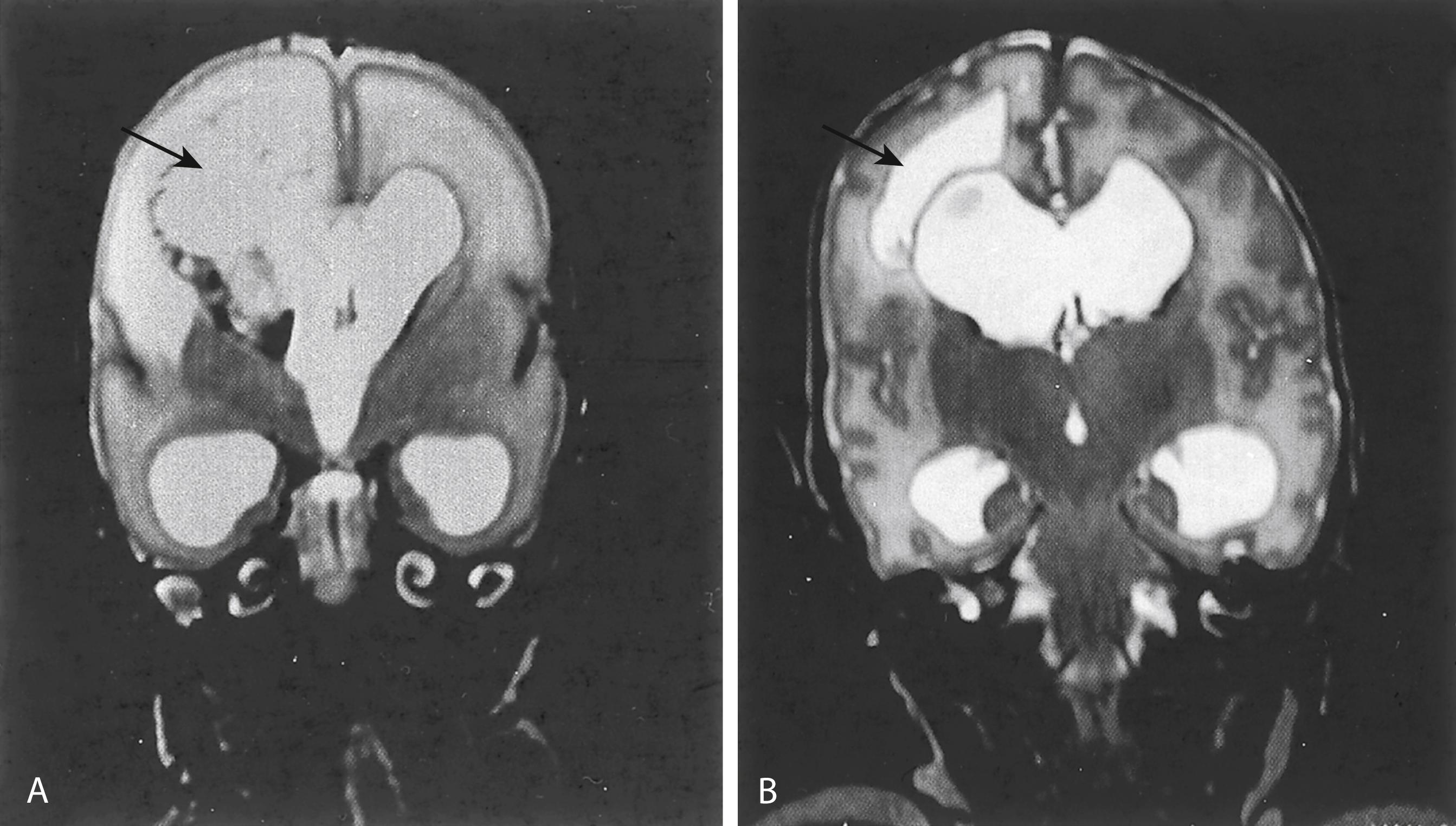 Fig. 131.5, Coronal T2-weighted magnetic resonance imaging scans of acute periventricular hemorrhagic infarction. (A) Note the fan-shaped distribution of increased signal in the parenchyma (arrow) and the generalized increased signal in the white matter in the area surrounding the infarct. (B) Later image of the same infant with cystic transformation of the infarct (arrow). Note the ventriculomegaly present in both images.