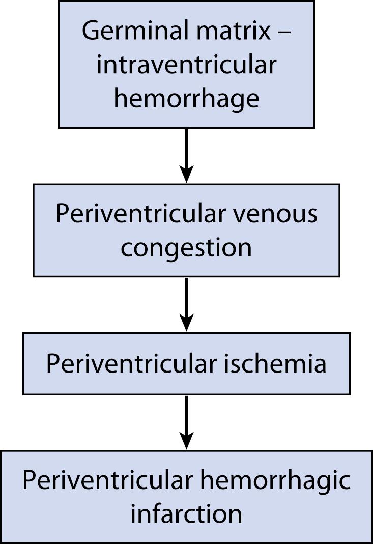 Fig. 131.6, Pathogenesis of periventricular hemorrhagic infarction. The formulation indicates a central role for germinal matrix hemorrhage–intraventricular hemorrhage in causation of the periventricular venous infarction.