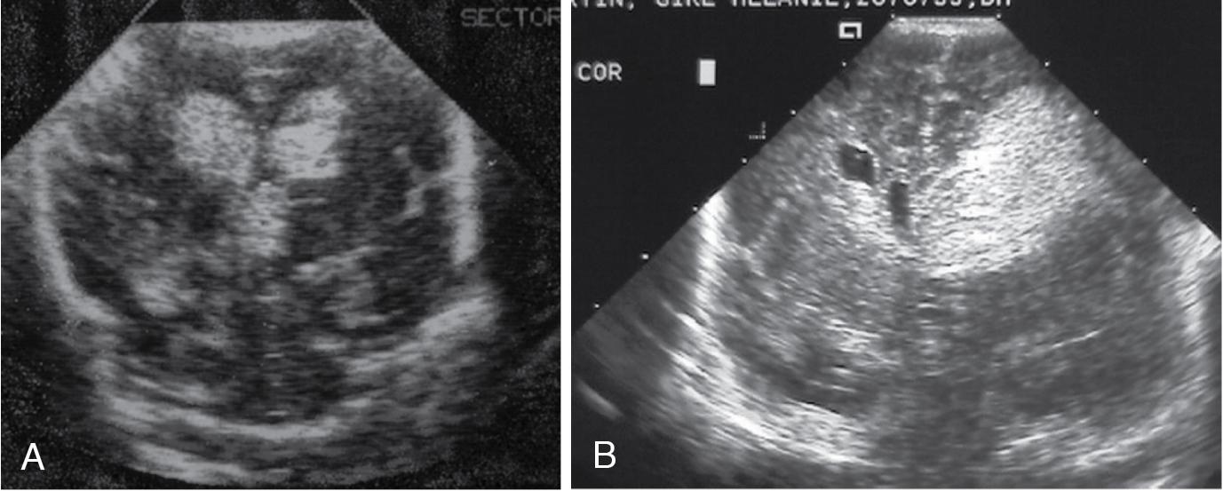 Fig. 3.1, Coronal ultrasound scans. A, Note a bilateral germinal matrix and intraventricular hemorrhage (grade III). B, Note the large left-sided germinal matrix and intraventricular hemorrhage. There is a large ipsilateral intraparenchymal echodensity involving periventricular white matter.