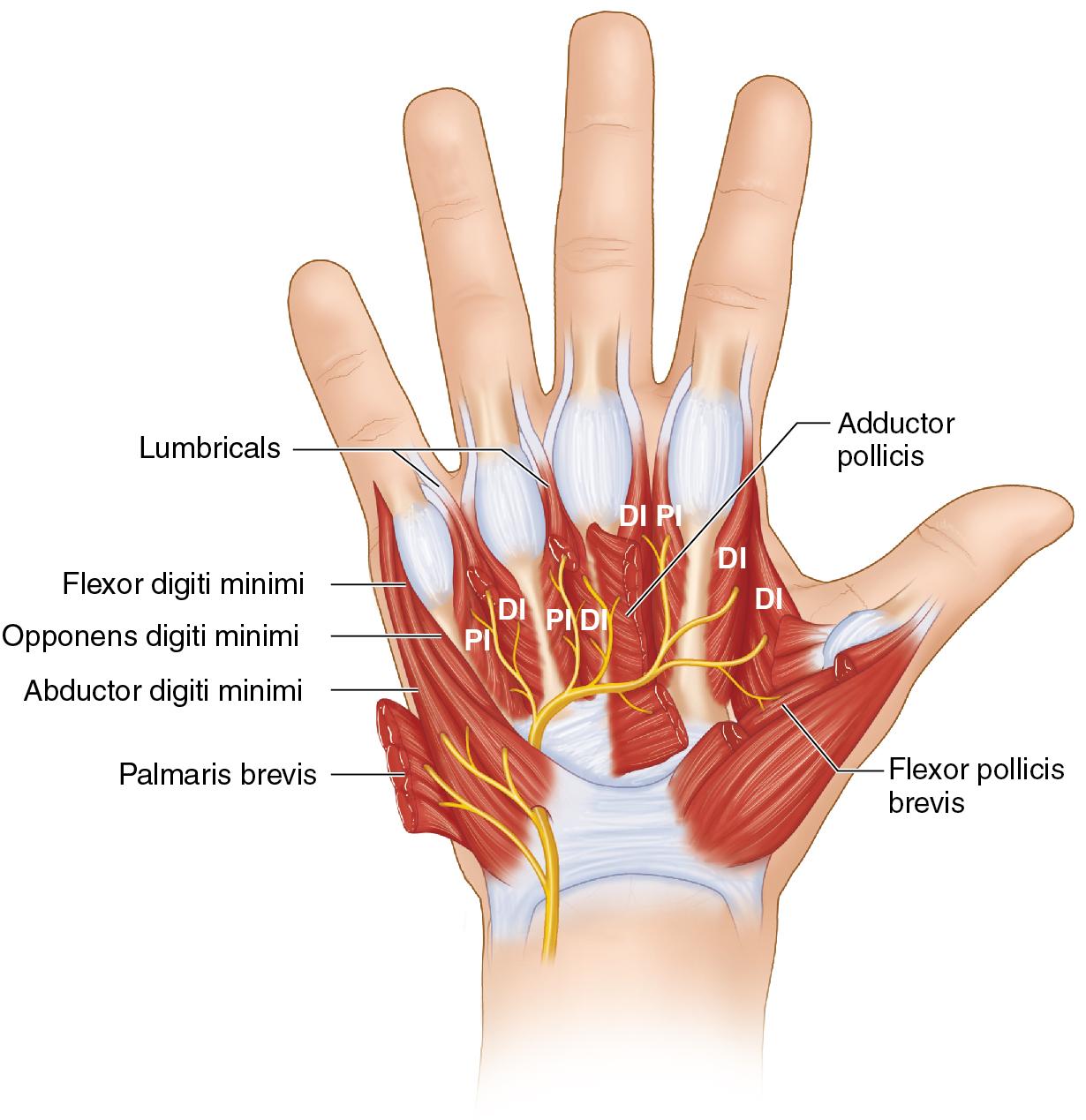 FIGURE 75.2, Innervation of interosseous muscles. DI , Dorsal interosseous; PI , palmar interosseous.